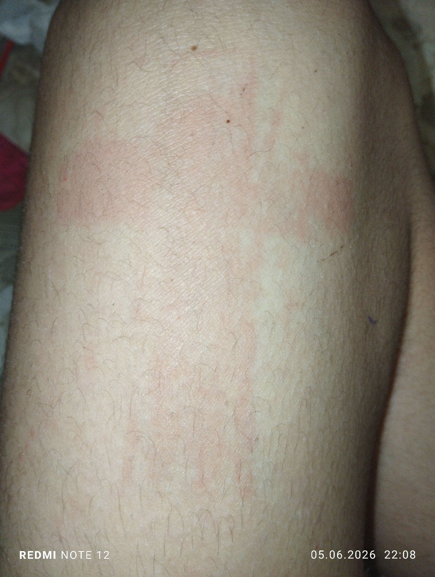 This image, captured in the city of Burgas, Bulgaria, on June 5, 2026, at 22:08, displays a close-up, forensic view of light-toned human skin, likely from a leg or arm, densely covered in fine to coarse dark hair. The primary subject is the skin, exhibiting multiple prominent erythematous (red) and elevated lesions, appearing as irregular plaques, streaks, and blotches consistent with urticaria (hives) or dermatographism. These marks vary in size and shape, with some clearly defined linear patterns and others forming broader, diffuse areas of redness and swelling. Several small, dark, punctate pigmented lesions, consistent with common moles or freckles, are scattered across the skin surface. A faint, thin, dark brown linear mark, possibly a scratch or minor debris, is visible in the upper right quadrant of the detailed view. Additionally, a very small, faint purple mark is discernible. The skin texture shows typical fine lines and pores. The lighting suggests an indoor environment. No other subjects, objects, or actions are discernable within the close-up frame.