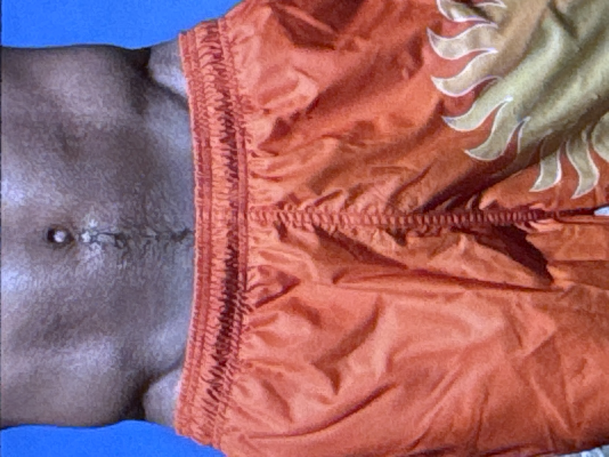 This is a close-up, overhead shot of a person's torso, specifically their abdomen and the upper part of their shorts. The person has a dark skin tone. There is a visible scar running vertically across their abdomen. They are wearing bright orange shorts that appear to be made of a lightweight, possibly nylon material. The shorts have a drawstring waistband and are adorned with a flame-like pattern in yellow and white. The background is a solid, bright blue. The lighting suggests it is daytime, and given the clothing, it is likely a warm climate. The image is cropped tightly, focusing on the details of the skin and the fabric of the shorts. No text is visible. The scene appears to be casual, possibly taken at a beach or pool given the attire and the blue background which could represent water or a bright sky. The mood is neutral, with no strong emotions conveyed.
