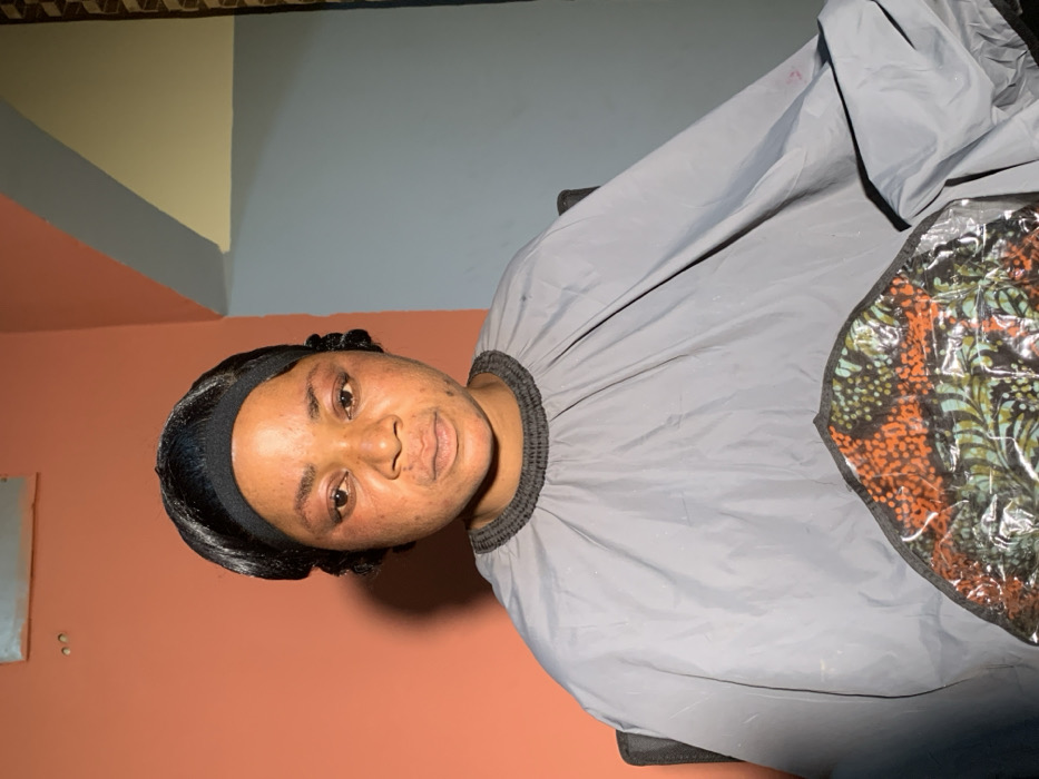 An adult female is depicted seated indoors in what is identified as Garaku, Nigeria. She faces the camera directly with a neutral expression. Her dark hair is styled back with a black headband, and ringlets are visible on the sides. Her face exhibits redness and puffiness, particularly around the eyes and upper cheeks, along with minor skin discolorations. She wears a grey, smock-style cape with a dark ribbed collar, covering her torso and arms. A clear plastic overlay on the lower right of the cape covers a section of patterned fabric displaying shades of orange, green, and black. The background consists of a salmon-orange wall directly behind her, transitioning to a light blue-grey wall section to her right (viewer's left), and a sliver of light yellow-beige wall above that. Two small dark marks are visible on the orange wall behind her head.