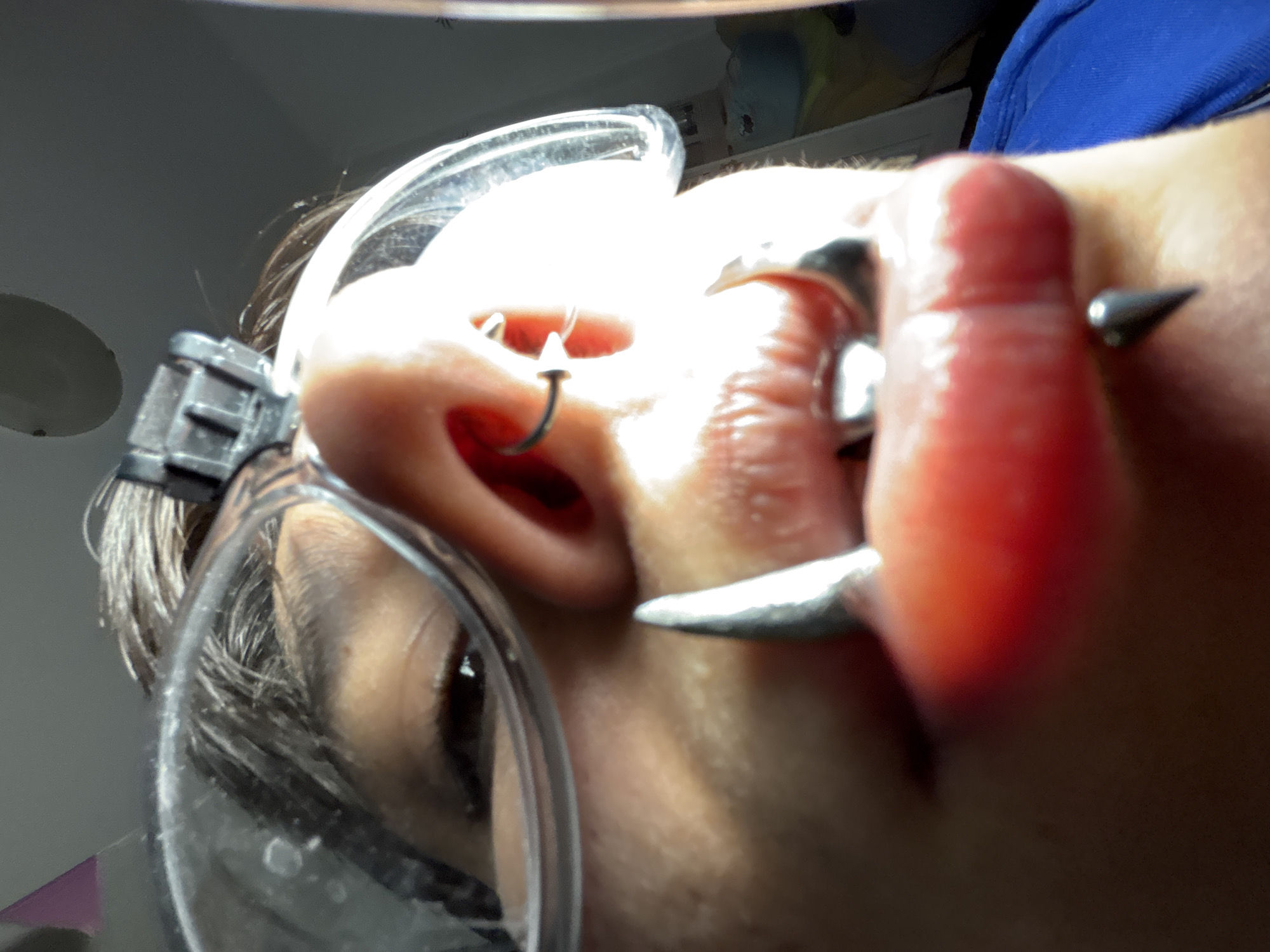 The image depicts a close-up, upward-angle view of a person's face. The person is wearing clear safety glasses with a black frame on the left side. A single eye is visible through the glasses, along with some dark hair. The person's ear is in focus and is pierced with a small hoop earring in the upper helix. The person's cheek is visible in the background, out of focus.
Dominating the foreground is the person's lower lip, which is being pulled down with a large, curved surgical instrument. The instrument is silver and has a pointed end.
The location is not discernible from the image. Sofia, Bulgaria cannot be determined based solely on the content of the image.