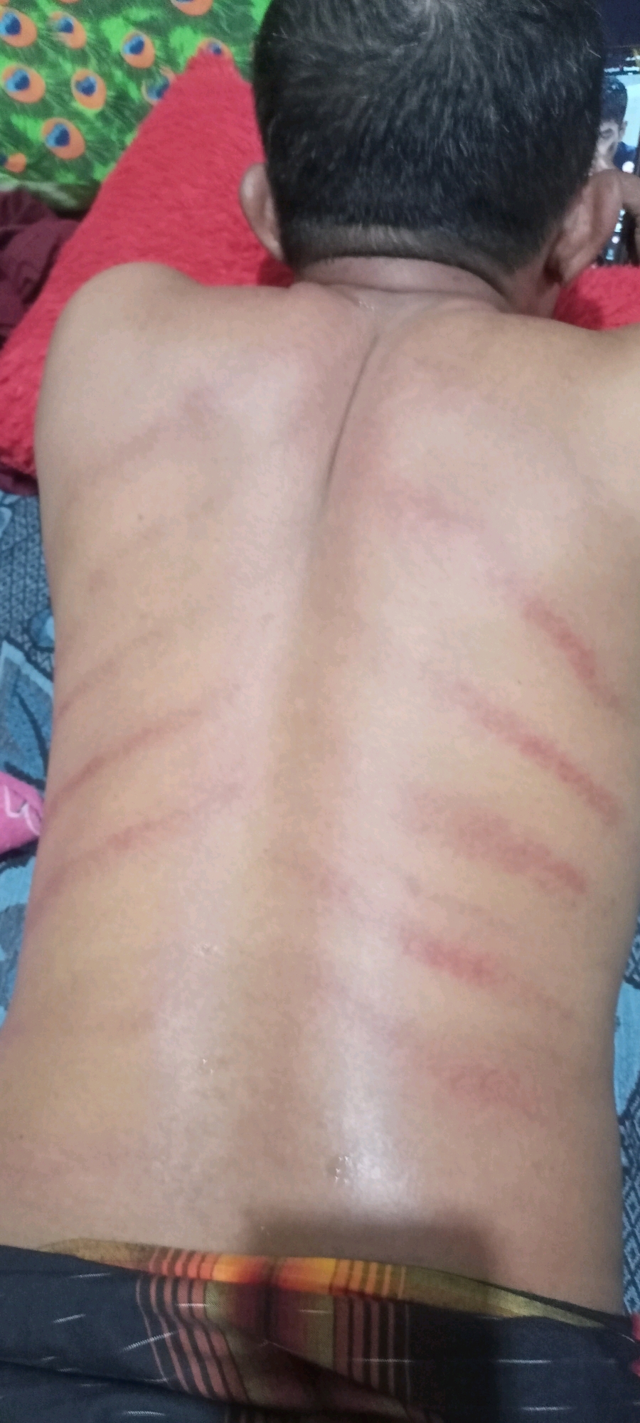 The image shows the back of a person with several red marks, likely bruises or welts, across their upper and mid-back. The person is lying down on a patterned surface, possibly a bed or mat. In the background, there are pillows with a peacock feather pattern and a red pillow. The lower part of the image shows the person wearing a sarong. The lighting suggests an indoor environment. No specific location in Gempolklutuk, Indonesia, can be identified from the image itself.