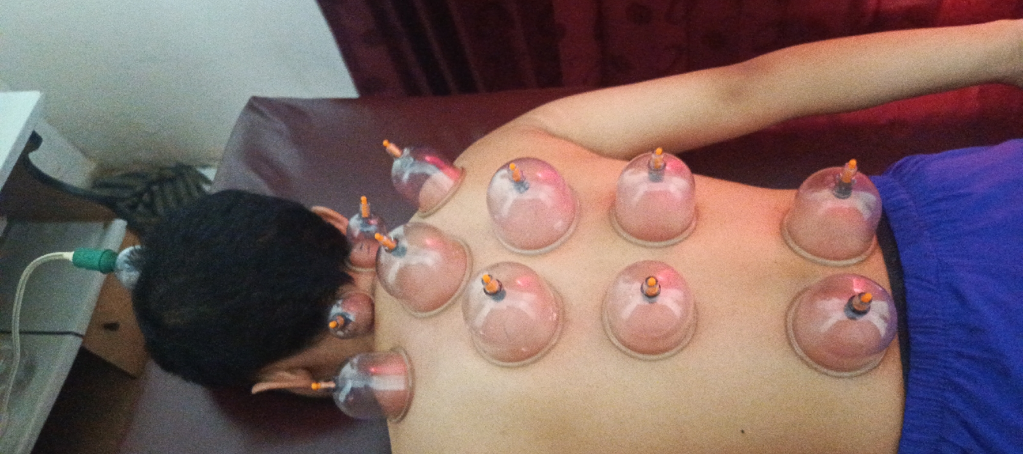 A person's back is covered in cupping therapy devices, with several translucent cups of various sizes attached to their skin. A green and white tube connects to one of the cups on the left side of the image. The person's dark hair is visible on the left, and their right arm is extended towards the top of the frame. The background consists of a reddish-brown surface, likely a massage table or bed, with a dark curtain visible behind it. The scene takes place indoors, possibly in a clinic or spa setting, located in Sukaresmi, Indonesia.