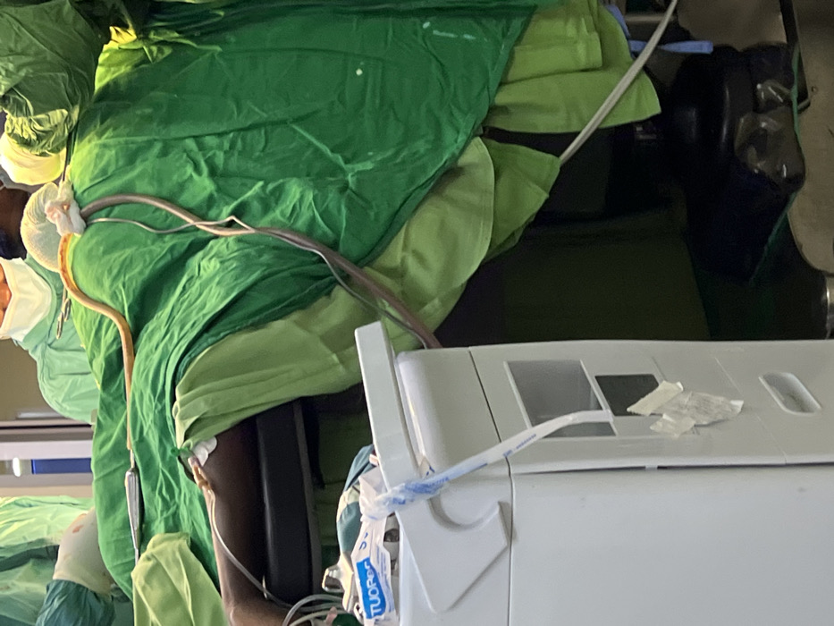 The scene depicts a medical procedure occurring in an operating room environment, presumed to be within Nairobi, Kenya, though the specific healthcare facility is not identifiable from the image.
An individual, likely a patient, is positioned supine on a dark-colored operating table, predominantly covered by layered green surgical drapes. A bare right forearm and a segment of the right upper thigh/knee are visible, with clear medical tubing connected to the forearm. A distinct, light brown, flexible tube emerges from beneath the dark green drape near the patient's upper torso/head area, extending horizontally across the drape. Several thinner, darker tubes or wires are coiled adjacent to this area. A silver-colored surgical instrument rests on the green drape to the patient's right side.
In the background, two individuals, presumably medical personnel, are partially visible, wearing green surgical scrubs and white surgical masks.
In the lower-left foreground, a white medical console or cart is present, with white medical tape used to secure a wire to its side. A blue and white package marked "TUOR" is attached to another white medical device positioned near the patient's visible arm. The overall environment is sterile and brightly lit, consistent with a surgical setting.
