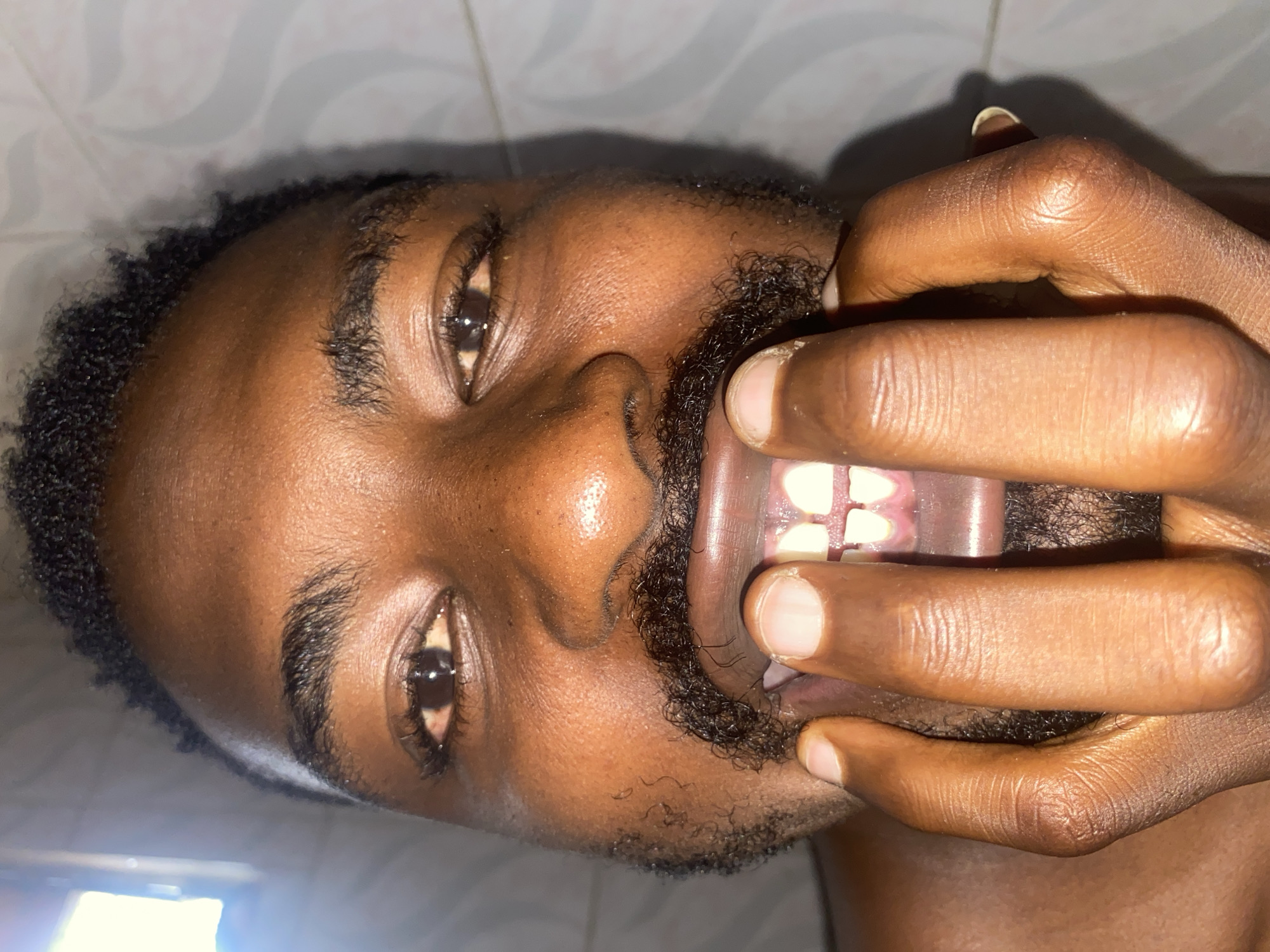 A close-up, sideways-oriented portrait captures a person with dark skin, short, curly black hair, and a black beard and mustache. His face is centered in the frame, with both dark brown eyes looking directly at the viewer. He is actively holding his mouth wide open with his fingers, using his thumb and index fingers to pull back the corners of his mouth. This action reveals his teeth and gums, along with a clear dental appliance, possibly a whitening tray or aligner, fitted over his upper teeth. The teeth beneath the appliance appear uniformly white. The background is a light-colored, blurry surface, possibly tiled, suggesting an indoor setting. The lighting creates a subtle shine on his skin. No text is visible. The location context for this media file is Barakin Akawo, Nigeria.