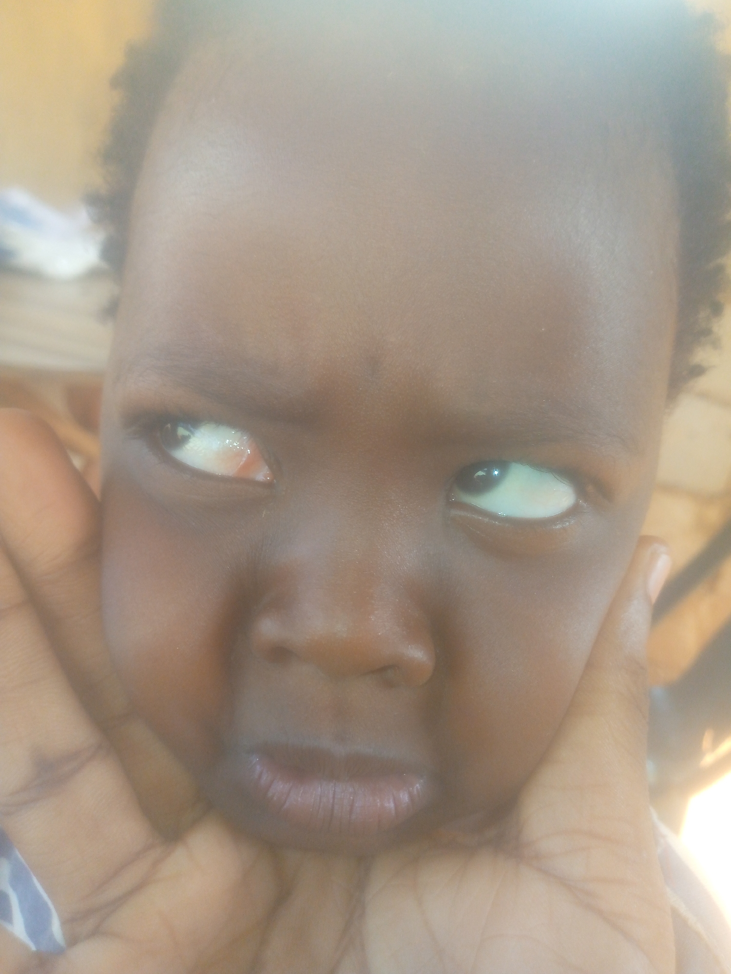 A close-up photograph shows the face of a young, dark-skinned child being cradled by an adult's hand. The child's expression appears concerned or apprehensive. The left eye exhibits a milky or cloudy appearance with redness, possibly indicating an infection or other medical condition. The other eye appears relatively normal. The location is Unknown, Unknown.