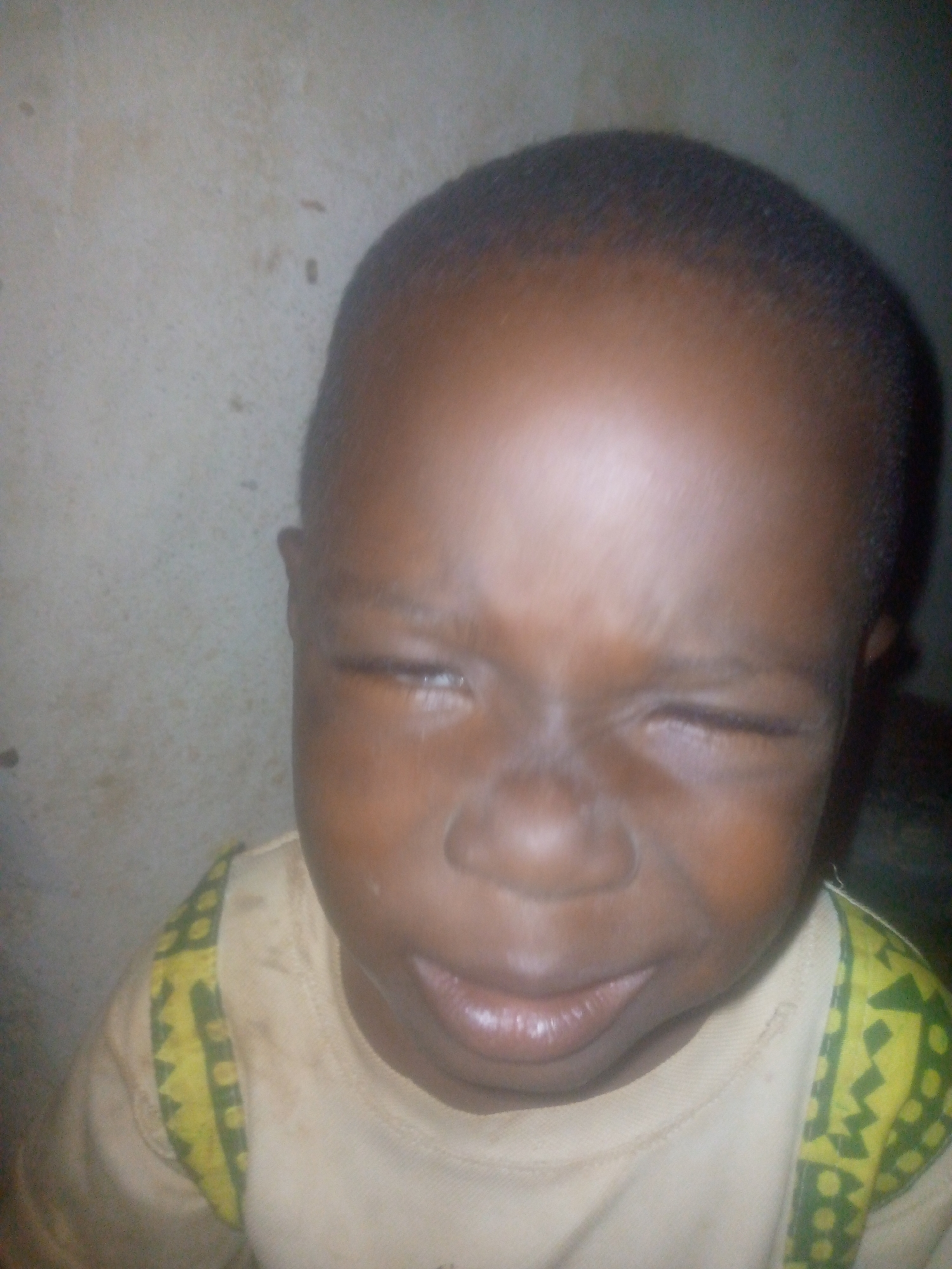 A young child with dark skin is shown in a close-up portrait. The child's eyes are mostly closed, and their facial expression suggests discomfort or squinting. The child is wearing a light-colored shirt with a pattern of yellow and green along the collar and shoulders. The background is a plain, light-colored wall. The location is Unknown, Unknown.