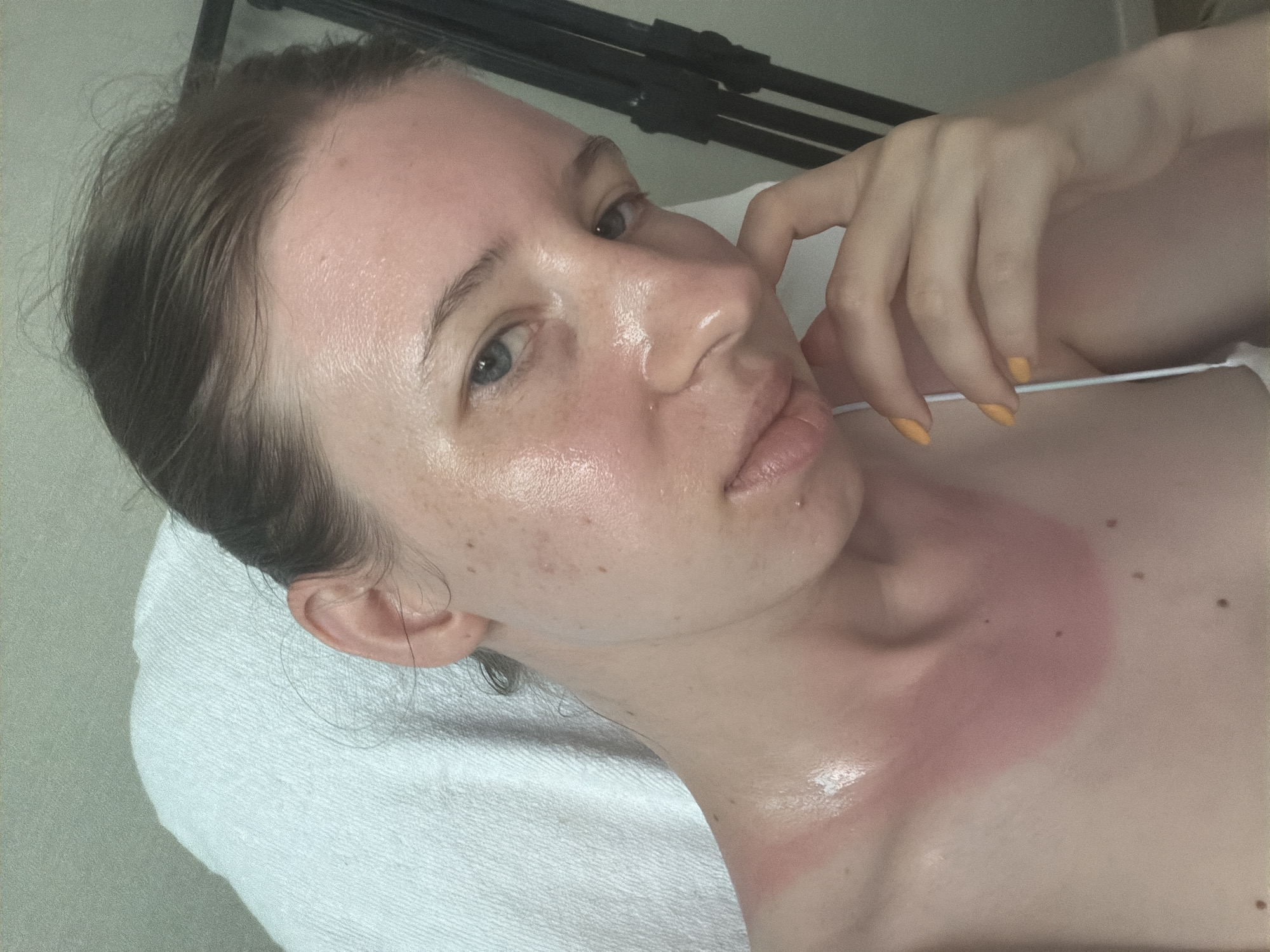 The image is a close-up, selfie-style photograph of a person's face and upper chest. The person has fair skin with freckles and appears to have a sunburn on their left shoulder and neck, characterized by a reddened area. Their hair is pulled back, and they are looking towards the camera with blue eyes. One hand is touching their face near their chin. The background is out of focus, but appears to be an indoor setting with a textured surface behind the person and a dark object with vertical lines to the right. There is no visible indication of the city of Dongducheon-si, South Korea in the image.
