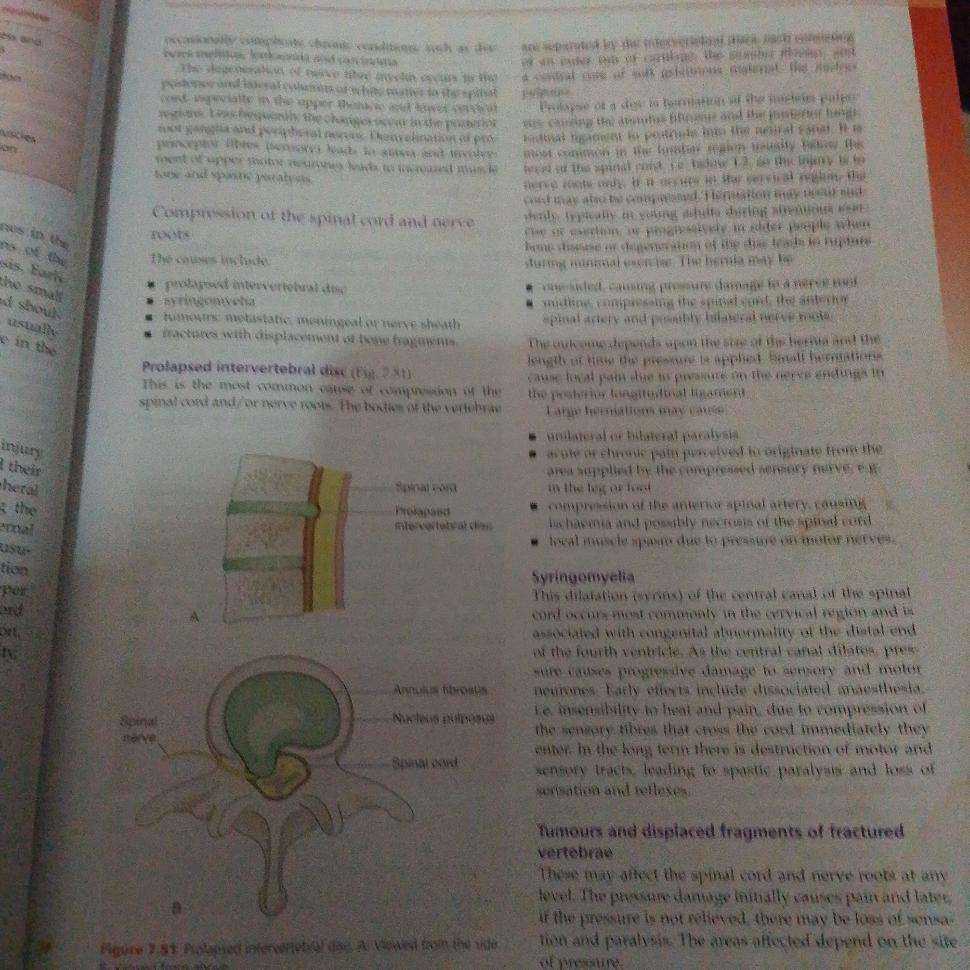 The image is a page from a medical textbook, displaying text and anatomical illustrations related to spinal cord compression. There are no elements in the image that suggest a location in Jalingo, Nigeria, or any urban setting. The content focuses on medical conditions, causes, and symptoms.