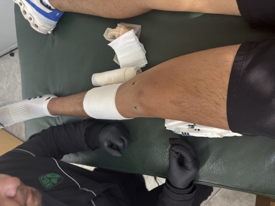 A patient lies on a green examination table. Their lower leg and knee are wrapped in white bandages, with stitches visible. Medical supplies, including gauze and tape, are scattered nearby. A medical professional, wearing a black long-sleeve shirt and black gloves, attends to the patient, their face partially visible in the lower left corner. The patient wears a white sock and a white and blue sneaker. Black shorts are visible around the upper thigh area.