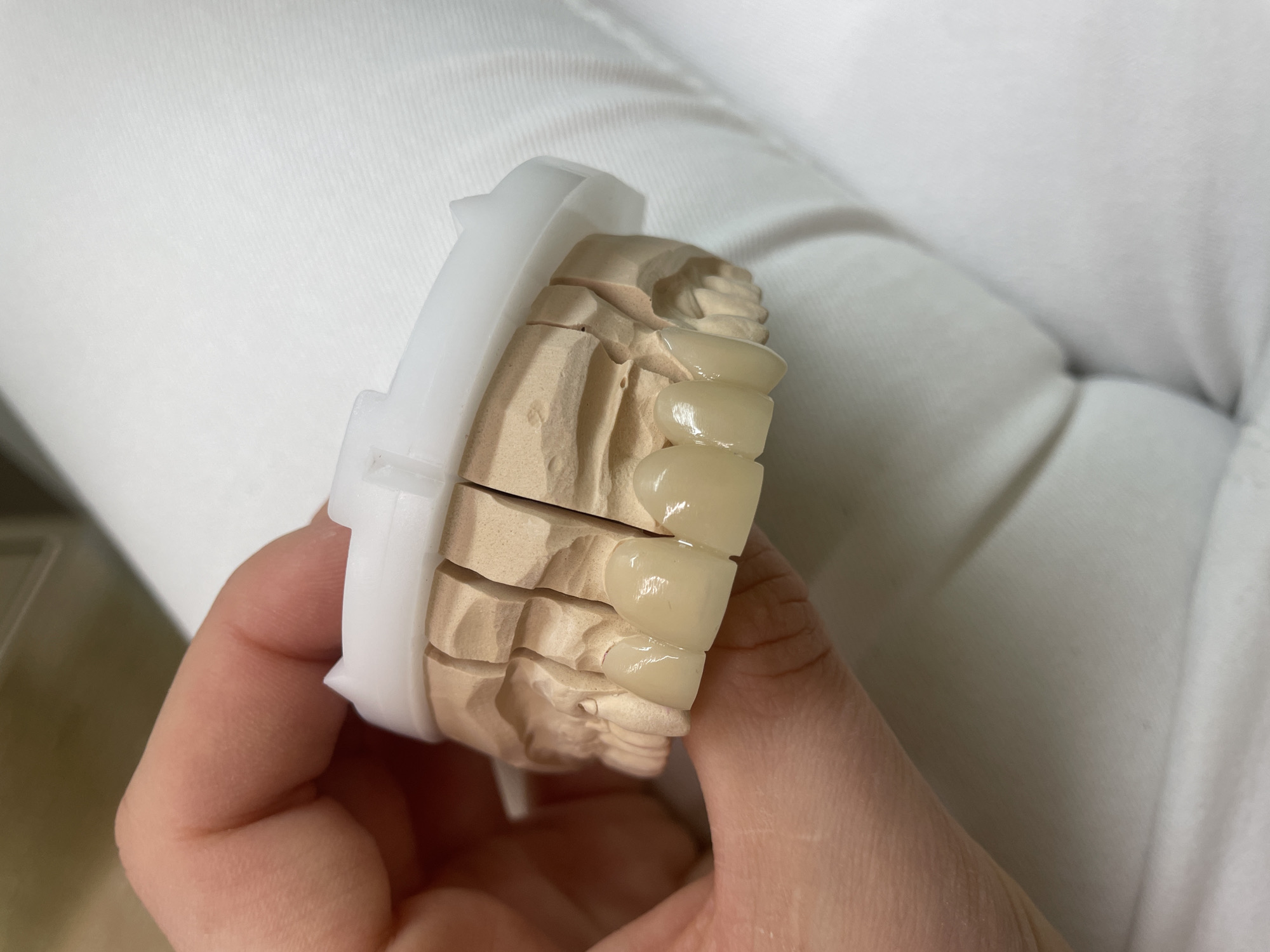 A close-up, eye-level shot shows a person's hand holding a dental model of teeth. The dental model is made of a light-colored, plaster-like material and is segmented into several pieces. It appears to be a partial upper jaw model, with some teeth missing and others represented by carved indentations. Attached to the front of the model are four highly polished, porcelain dental crowns, with a natural tooth color. These crowns are smooth and translucent, showing a slight sheen. A white plastic retainer or frame is visible around the top of the dental model, securing it. The background consists of a soft, white, textured surface, possibly fabric, which is out of focus. The lighting is bright, highlighting the details of the dental work and the texture of the hand and the model. The image is sharp and focused on the dental model and the hand.
