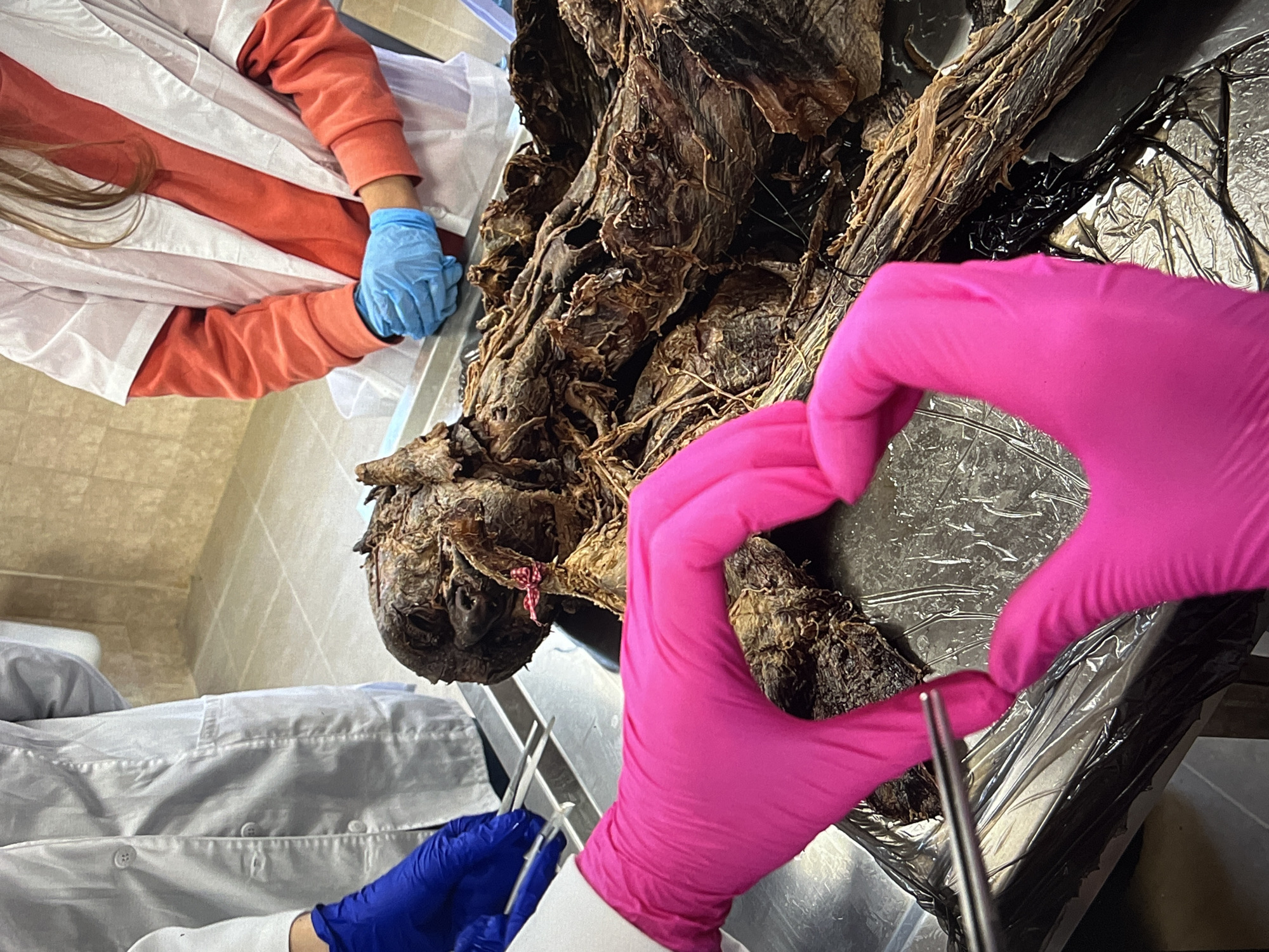 The image shows a dissection of a human cadaver, likely in an anatomy lab. Two people are visible, wearing lab coats and gloves. One person wears blue gloves, while the other wears pink. The cadaver is positioned on a dissection table covered with a metallic or foil liner. The person with pink gloves is forming a heart shape with their hands. The location is likely an anatomy lab in an unknown city and country.