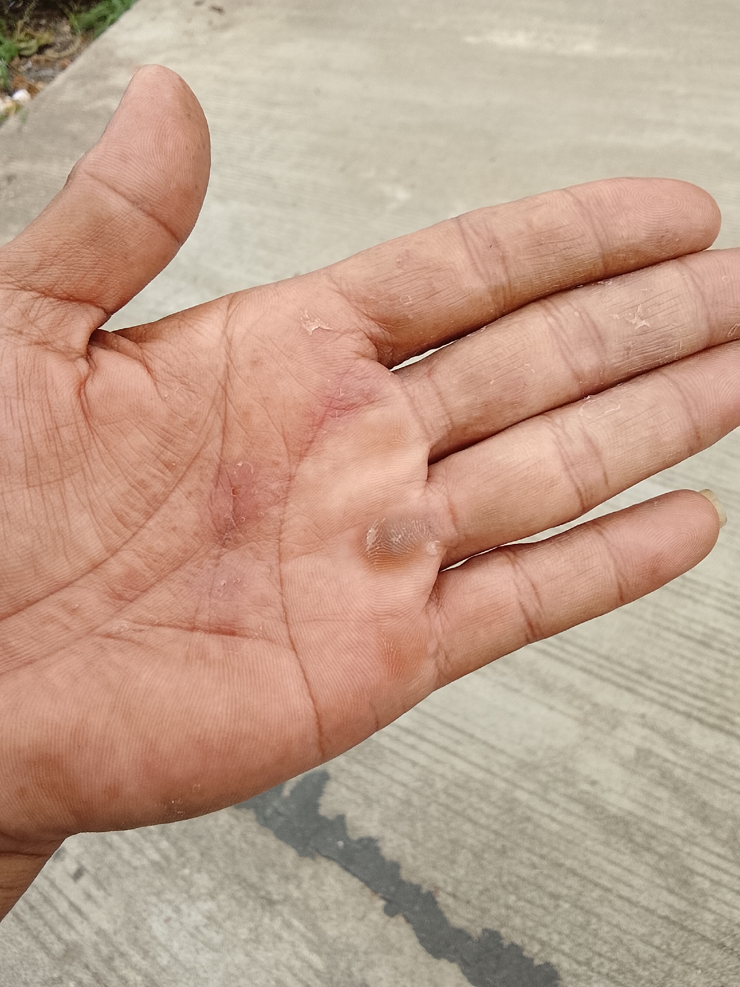 The image shows a close-up of a person's palm, which appears to have dry, flaky skin and some redness in the center. There is also a small blister or callus on the lower part of the palm near the base of the thumb. The background is a textured gray surface, possibly concrete, with some green vegetation visible at the top left corner. The lighting suggests it is daytime. The image does not contain any information that would allow for the determination of a specific location in the city of Padang Dalom, Indonesia.