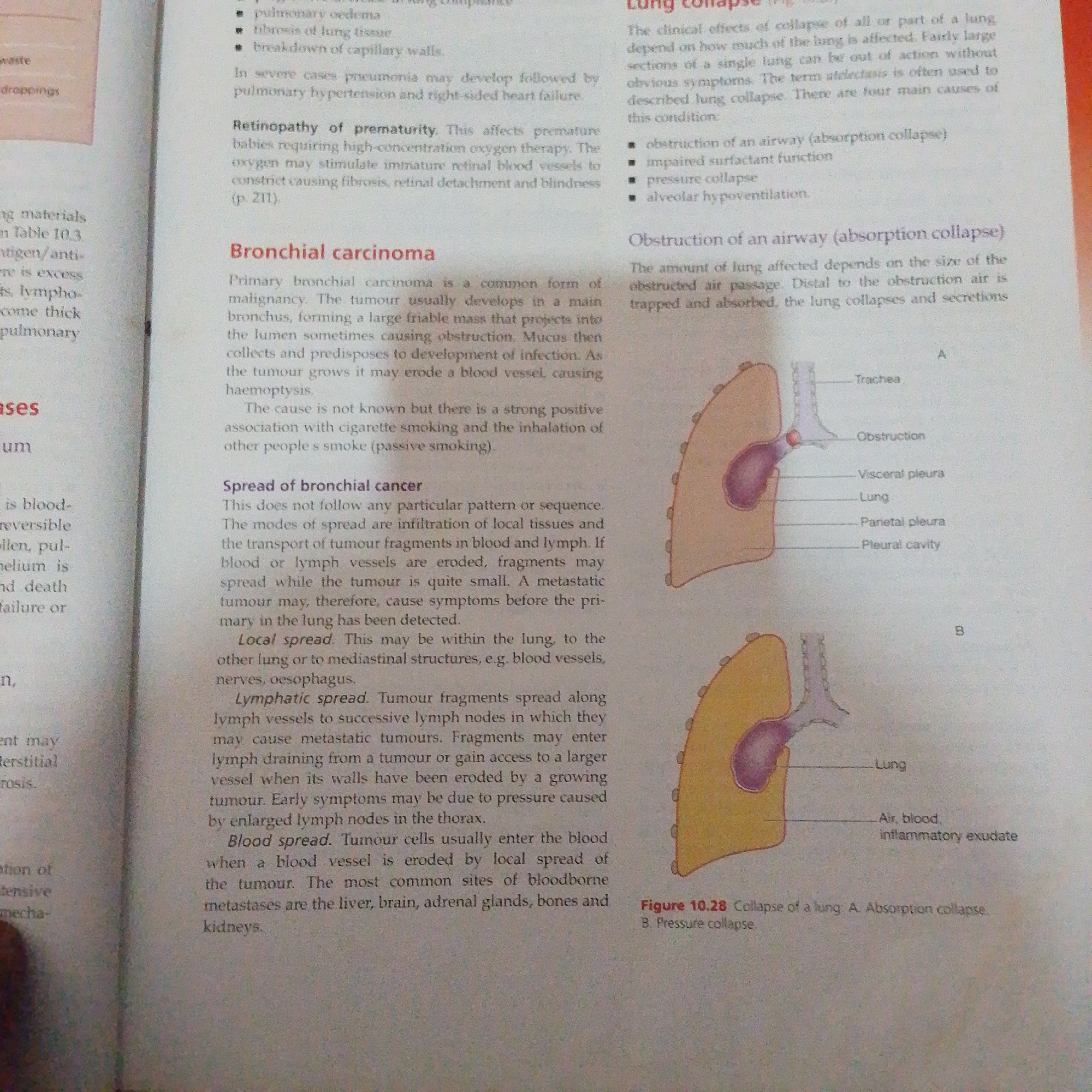 This media file is a photograph of an open textbook page. The page contains several sections of text and two diagrams. The text discusses medical conditions related to the lungs, including "Bronchial carcinoma," its spread, and "Lung Collapse." One section is titled "Obstruction of an airway (absorption collapse)" and is accompanied by a diagram labeled "Figure 10.28 Collapse of a lung: A. Absorption collapse B. Pressure collapse." The diagram illustrates a lung with an airway obstruction. There are no people or specific location cues from Jalingo, Nigeria, visible in the image. The content is educational, pertaining to human anatomy and pathology. The lighting suggests an indoor environment, likely a classroom or study area. The visible text is in English.