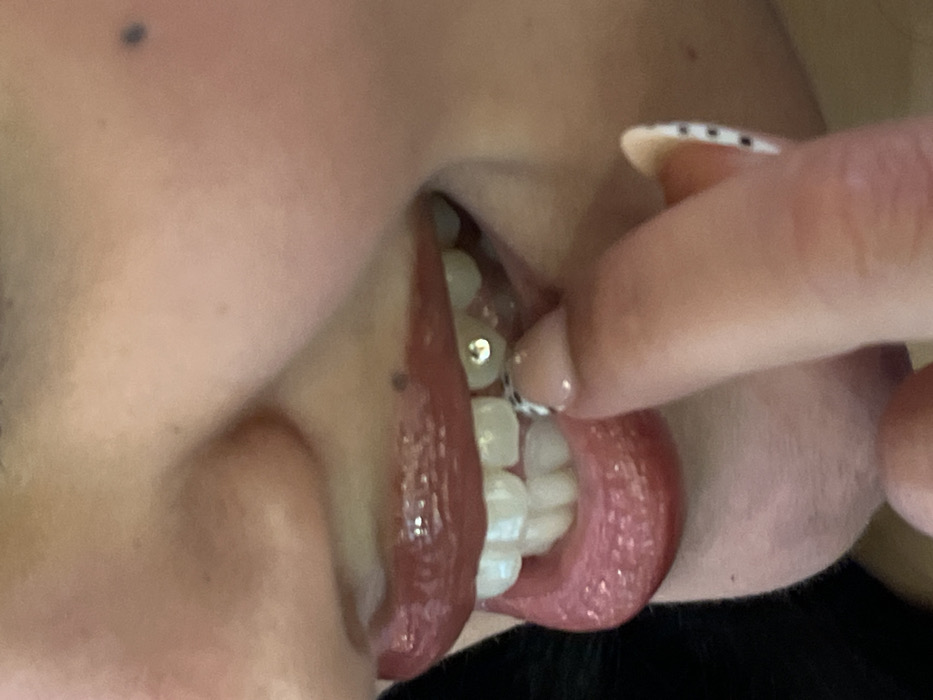 A close-up, slightly rotated view showcases a person's teeth. One tooth is adorned with a sparkling gem. The lips are glossy, and a finger presses against the front teeth, revealing a nail with a dotted design. The skin tones are fair, with a mole visible on the cheek. A dark garment is partially visible at the bottom of the frame.