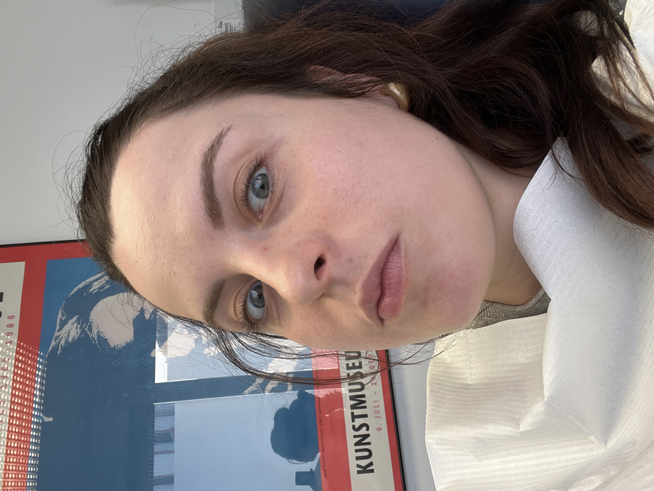 A female individual is depicted in a medium-shot, from the mid-chest upward, seated in what appears to be a dental or medical examination chair. She has fair skin, dark brown hair, and light-colored eyes, which are wide-open and directed towards the viewer. Her mouth is slightly pursed. A white, textured disposable dental bib is secured around her neck and upper torso. A gold-colored stud earring is visible on her right ear. In the background, a white wall holds a framed poster. The poster features a graphic design with red and blue sections, displaying the text "KUNSTMUSEUM," "9. JULI - 1986," and "Andy Warhol: Selbstbildnis, 1967. Siebdruck" in white lettering. Reflections, possibly from a window or light source, are present on the poster's surface, along with a dark silhouette. The scene takes place within a medical or dental clinic in Monsheim, Germany.