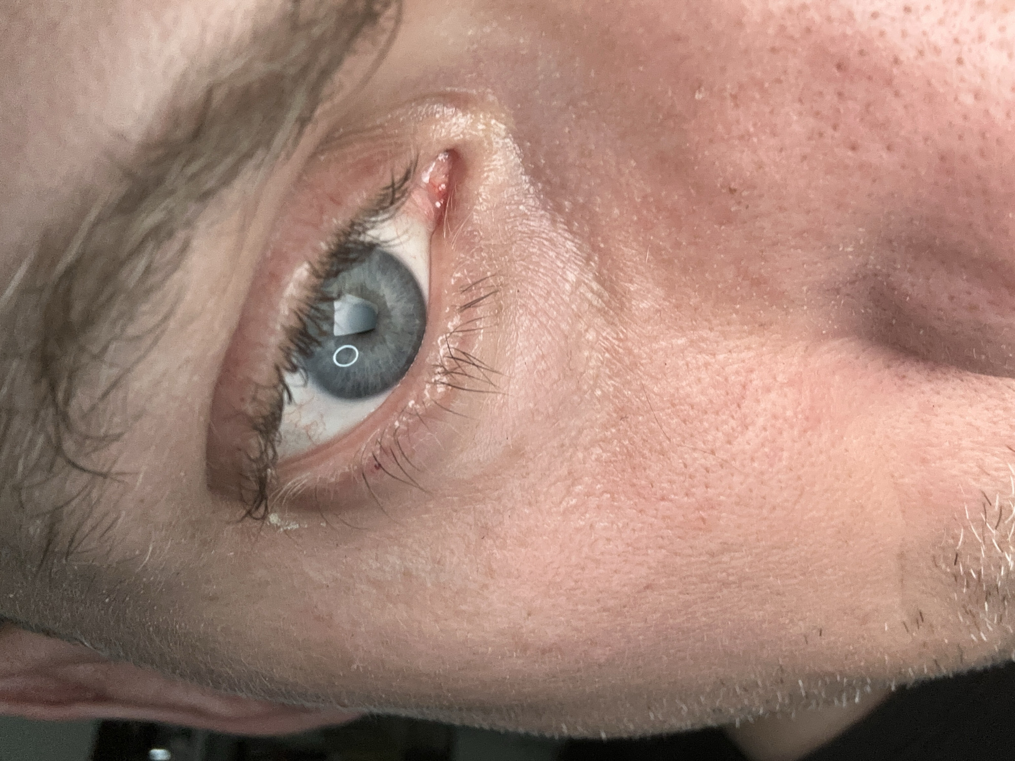 A close-up, eye-level shot focuses on the right eye and surrounding facial skin of a fair-skinned individual. The iris is a light blue with a subtle ring reflection from an unseen light source. The sclera is clear, and eyelashes are visible. A small, reddish lump, possibly a stye or other minor skin irritation, is present on the lower eyelid near the inner corner. The skin on the cheek shows texture, pores, and a few scattered dark spots, with some light stubble visible along the jawline and cheekbone. The eyebrows are light brown and appear somewhat sparse. The background is dark and out of focus, providing no environmental context. The image was captured in Moscow, Russia.