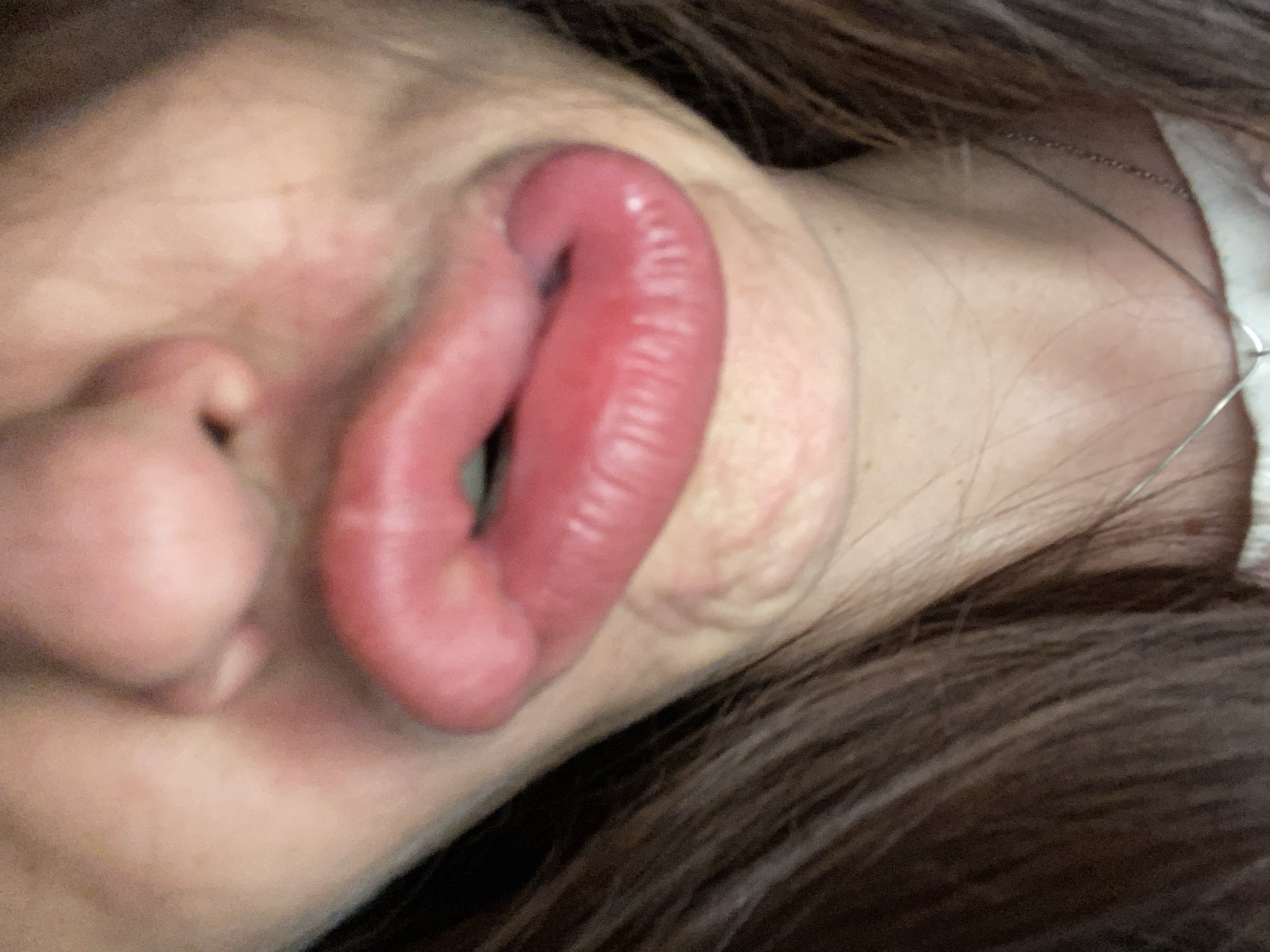 A close-up, tilted, and distorted image of a person's face. The focus is primarily on their prominently swollen lips, which appear red and inflamed. Parts of the person's nose and cheek are also visible, showing signs of redness. The person's hair is brown and falls around their face and neck. There is also a silver chain visible near the person's neck. The location and time are indiscernible.