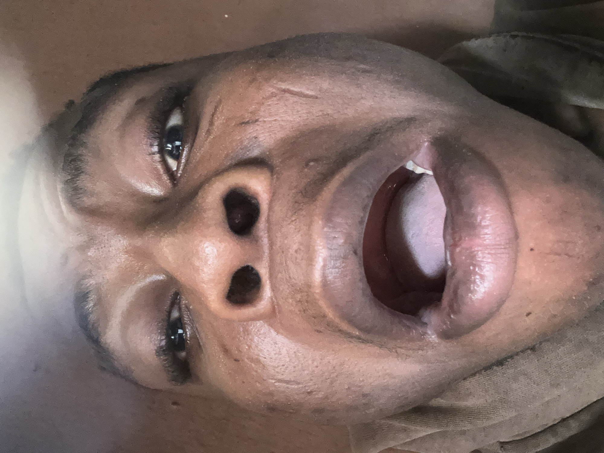 A close-up, tilted perspective of a Black male's face, mouth open. The subject has dark eyes, a wide nose with visible nostrils, and dark eyebrows. There are linear marks or possible scars on the forehead. The mouth is open, revealing the tongue and the interior of the mouth. The subject is wearing what appears to be a cloth garment around the neck. The location and city are unknown.