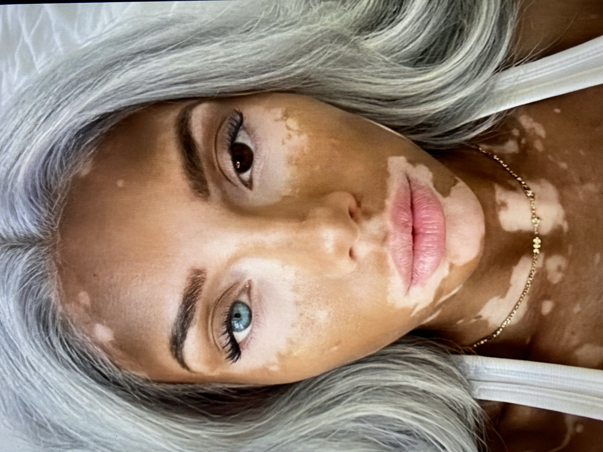 A close-up portrait shows a woman with vitiligo, a condition causing patches of depigmentation on the skin. She has ash-blonde wavy hair, one brown eye, and one blue eye (heterochromia). She's wearing a white tank top and a gold chain necklace. The image is framed from the chest up, with her face angled towards the camera. The background appears to be a white surface. No context indicates the location as Solikamsk, Russia, or any city.