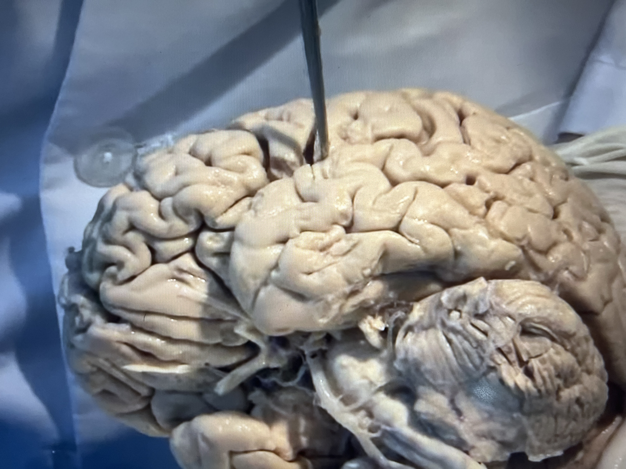 A human brain lies on a white surgical surface. A thin, metallic probe is inserted into the frontal lobe, between two gyri. The brain appears to be preserved, possibly for anatomical study or forensic examination. The brain’s overall color is a pale, yellowish-white. Below the cerebrum, complex structures, possibly the cerebellum and brainstem, are visible. The surrounding environment includes part of a white surgical gown or sheet. The location is unknown.