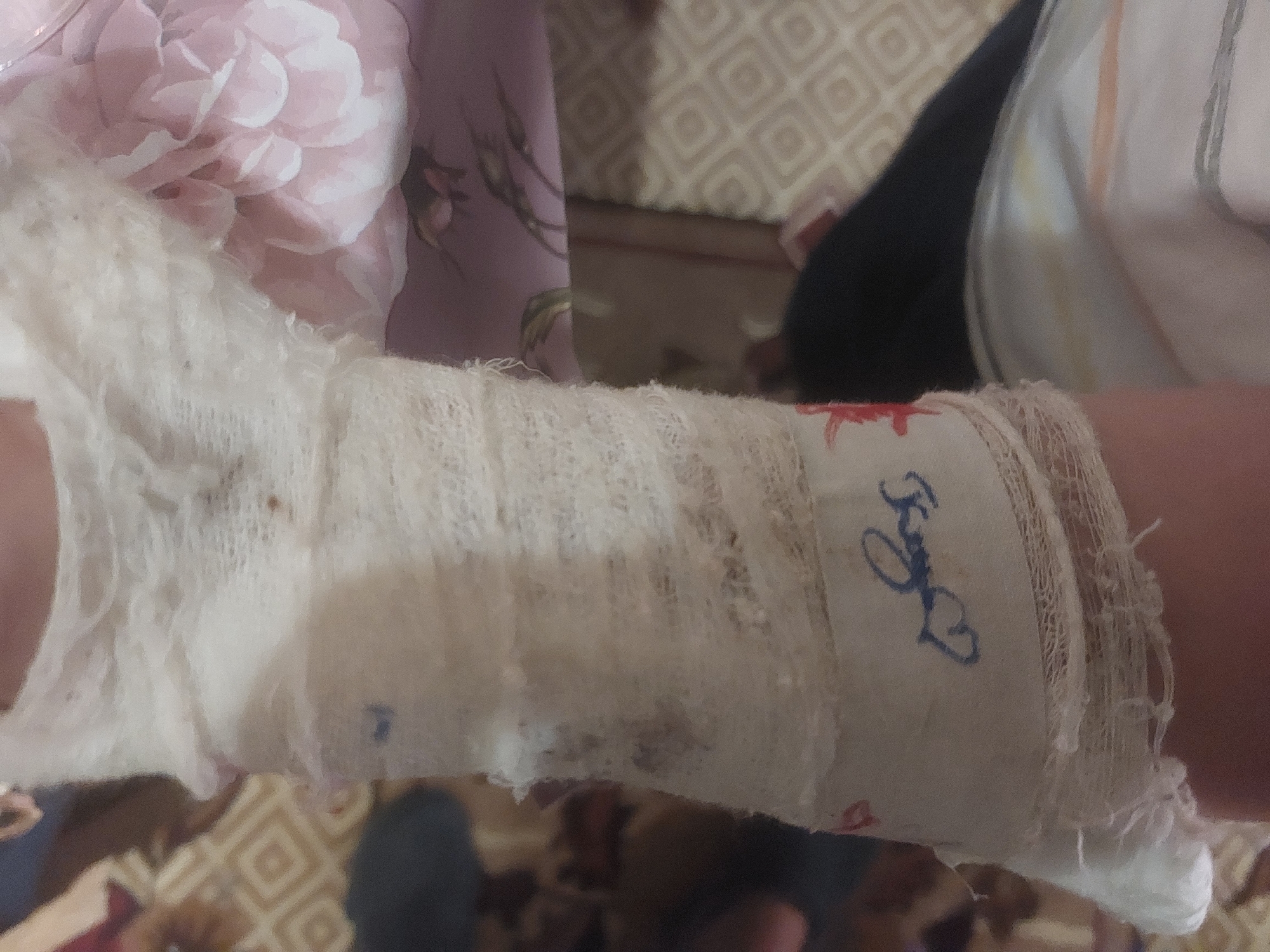 A close-up shot features a person's arm, heavily bandaged with a white gauze or fabric wrap. A blue signature-like design, featuring swirls and a heart-like element, is visible on the bandage. The wrapping extends from the hand up the forearm. The background includes a floral-patterned fabric and a geometric patterned surface, possibly a table or floor. The environment does not provide enough information to determine a location in Tsarevo, Bulgaria.