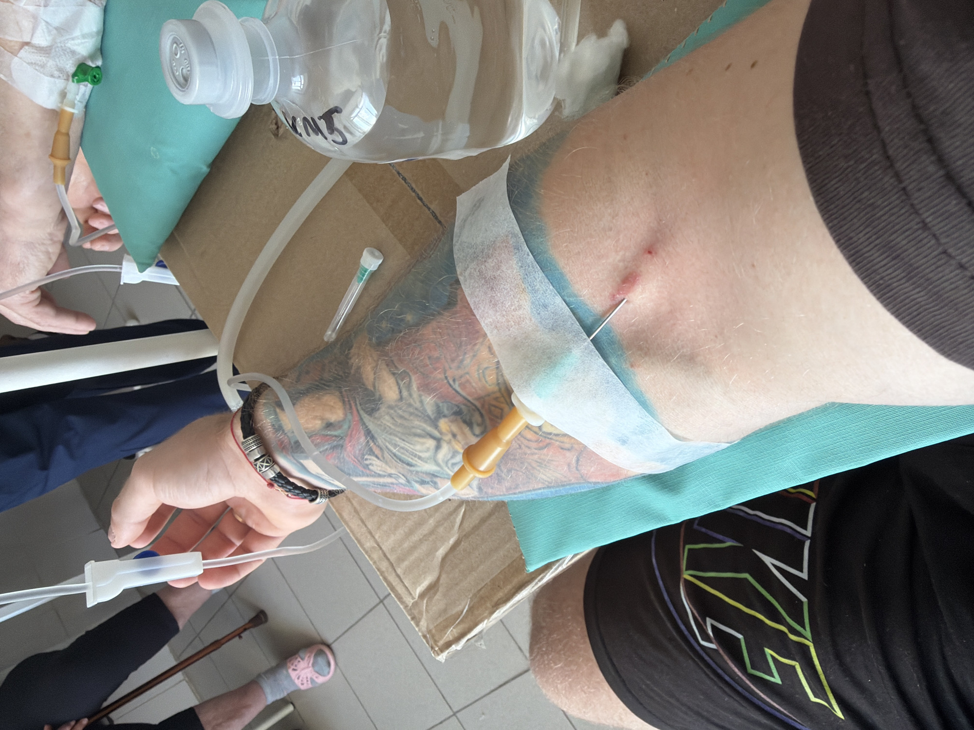 The image depicts a medical scenario, likely an intravenous (IV) infusion, with two individuals visible. A patient's arm is visible, with an IV needle inserted and taped in place. The arm is tattooed and adorned with bracelets on the wrist. A clear IV bag labeled "KNT" rests on a cardboard box next to the arm. Medical tubing connects the IV bag to the needle in the arm. Another person's hand is partially visible, holding the IV tubing.
The setting appears to be indoors, on a tile floor. Other details include a medical cane, a pair of slip-on shoes, and another person's legs wearing black pants.
There is no information to link the picture with Chaikovsky, Russia.