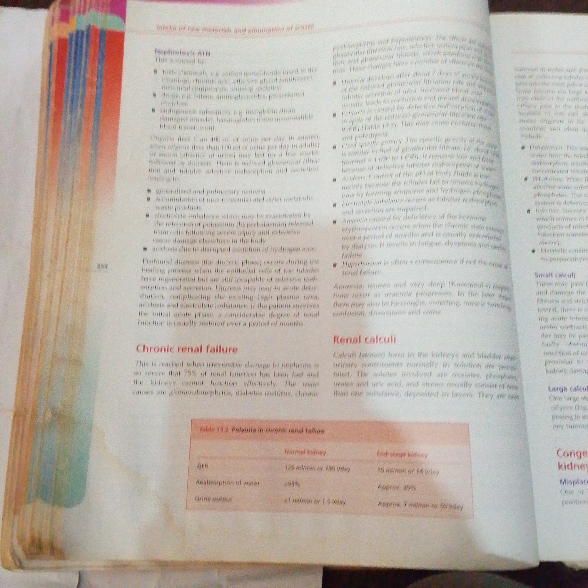 The image displays pages from a medical textbook. The left page discusses Nephrotoxic ATN (Acute Tubular Necrosis) and Chronic Renal Failure, with a table detailing Polyuria in chronic renal failure comparing normal kidneys to end-stage kidneys. The right page begins a section on Renal Calculi (kidney stones), with subheadings for Small Calculi and Large Calculi. The content is dense with medical terminology and explanations of kidney-related conditions.
The image does not contain any information that can be used to determine a location in Jalingo, Nigeria, or any elements related to forensic investigation.