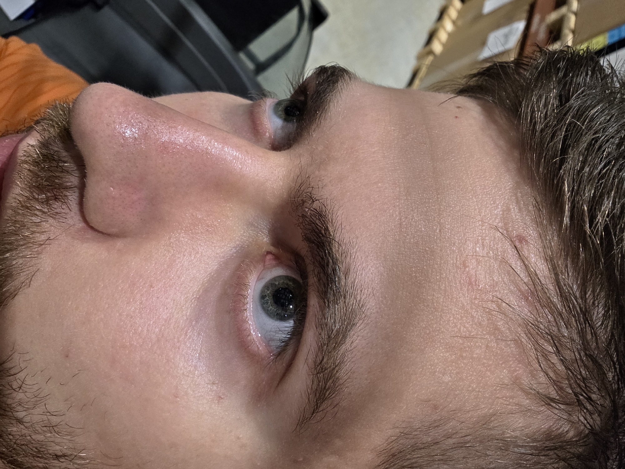 A close-up, side-profile image captures the head of a person, likely male, looking upwards. The subject has fair skin, dark brown hair on the head, eyebrows, and visible stubble along the jawline and cheek. Their eye, with a blue-green iris and black pupil, is prominent, showing the whites of the eye and eyelashes.
Notable details include a somewhat shiny or oily appearance on the skin of the nose and forehead, with visible pores. There are a few small reddish blemishes or marks on the bridge of the nose and several small, red-tinged marks or scars on the forehead near the hairline. The person's expression appears neutral or focused as they gaze upwards.
The background is out of focus, showing indistinct indoor elements, including what appears to be part of a dark piece of furniture or equipment and some lighter, possibly wooden or cardboard objects further back. No text is visible in the image. The setting is indoors, with artificial lighting highlighting the skin's sheen. The crops provide closer views of the skin texture, pores, facial hair, and the eye.