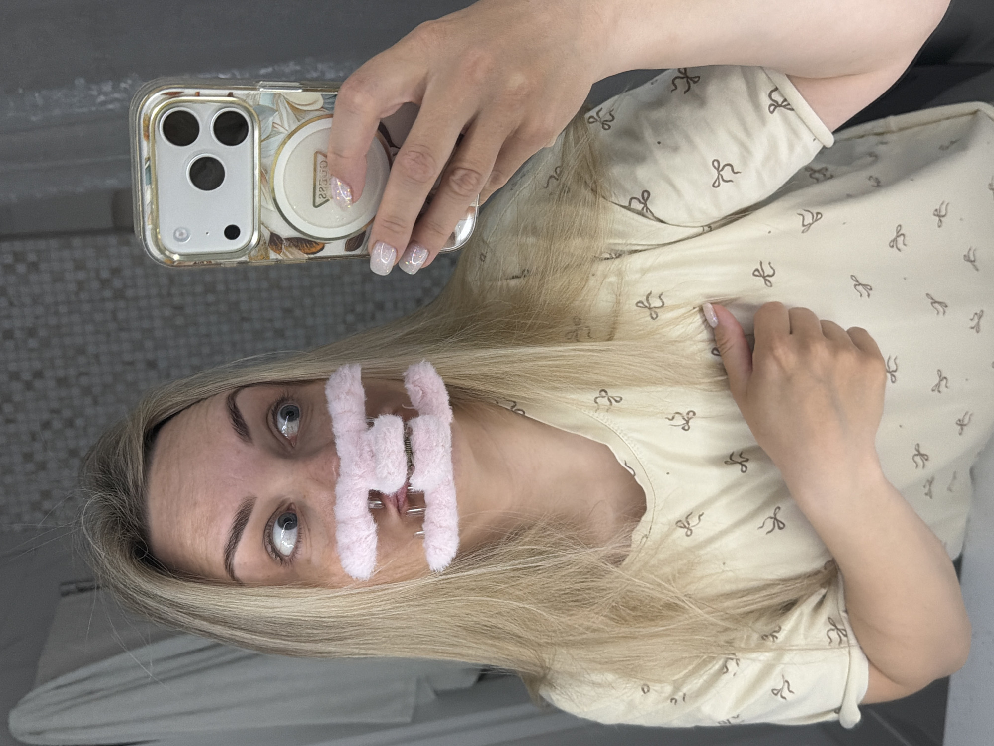 A blonde-haired woman is taking a selfie. She is wearing a surgical bandage over her nose and staples are visible. She is wearing a light-colored shirt with a bow pattern. She is holding an iPhone in a decorative case. The location appears to be a bathroom with gray and white tiling. There is no indication of the city of Votkinsk, Russia.