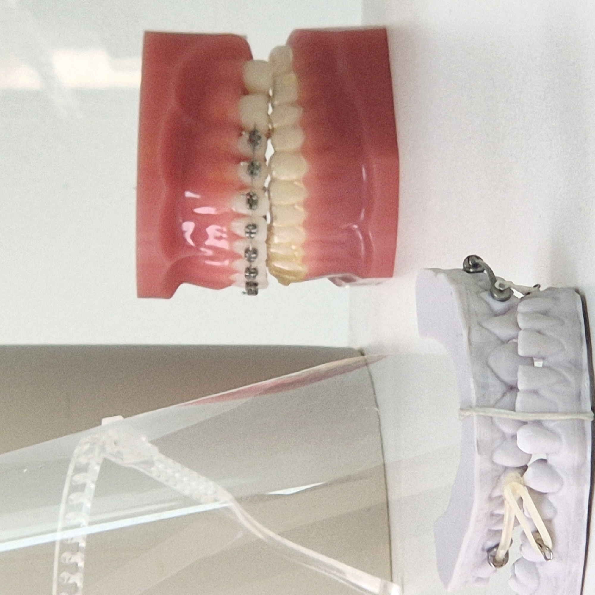 A photograph features two dental models displayed within a case. One model is a set of dentures, complete with pink gums and white teeth, and equipped with braces. The adjacent model is a cast impression of teeth, likely crafted from plaster, held together with a rubber band and orthodontic elastics. The overall setting suggests a dental or orthodontic office, possibly located in Strasbourg, France.