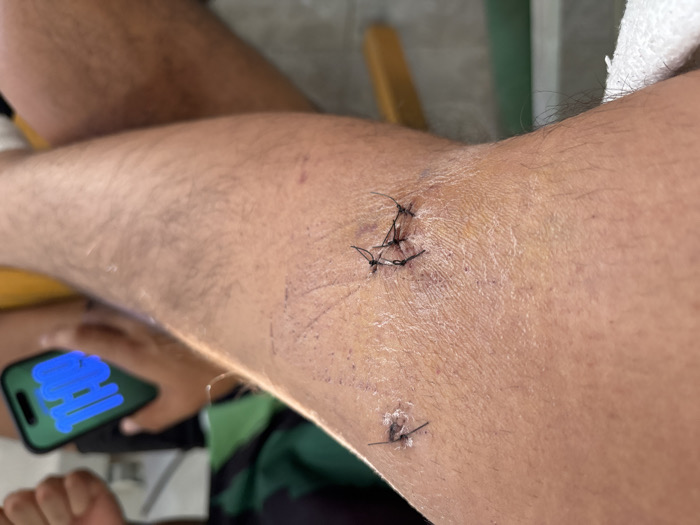 The image displays a close-up view of a human limb, likely an arm or a leg bent at a joint, revealing multiple sets of sutures. The skin tone is medium, and there is visible hair on the limb.
The primary focus is on two distinct areas where sutures are present. The most prominent set of sutures is located towards the upper part of the image, possibly on or near an elbow or knee joint, given the slight crease in the skin. Here, several black threads are visible, forming a star-like or crisscross pattern over a small, reddish, and slightly raised area, indicating a recent wound or incision. Faint, dark blue or purple lines, resembling marker markings often used in medical procedures, are visible on the skin around these sutures.
Further down the limb, towards the lower right, another smaller set of sutures is visible. This one appears to consist of two black threads, securing a smaller incision or puncture wound. The skin around this smaller set of sutures also shows some discoloration.
In the lower left portion of the image, a hand with medium skin tone is partially visible, holding a dark-colored smartphone. The phone's screen is illuminated with a bright blue light, displaying blurred, abstract blue shapes, possibly a drawing or an application interface. Below the hand, a green and black patterned fabric, likely clothing, is discernible. To the upper right, a section of white, textured material, possibly a towel or bandage, is partially wrapped around or resting on the limb. The background is mostly out of focus but suggests an indoor setting with subtle hints of furniture or other objects.
The overall scene depicts a limb recovering from a medical procedure that required stitches.