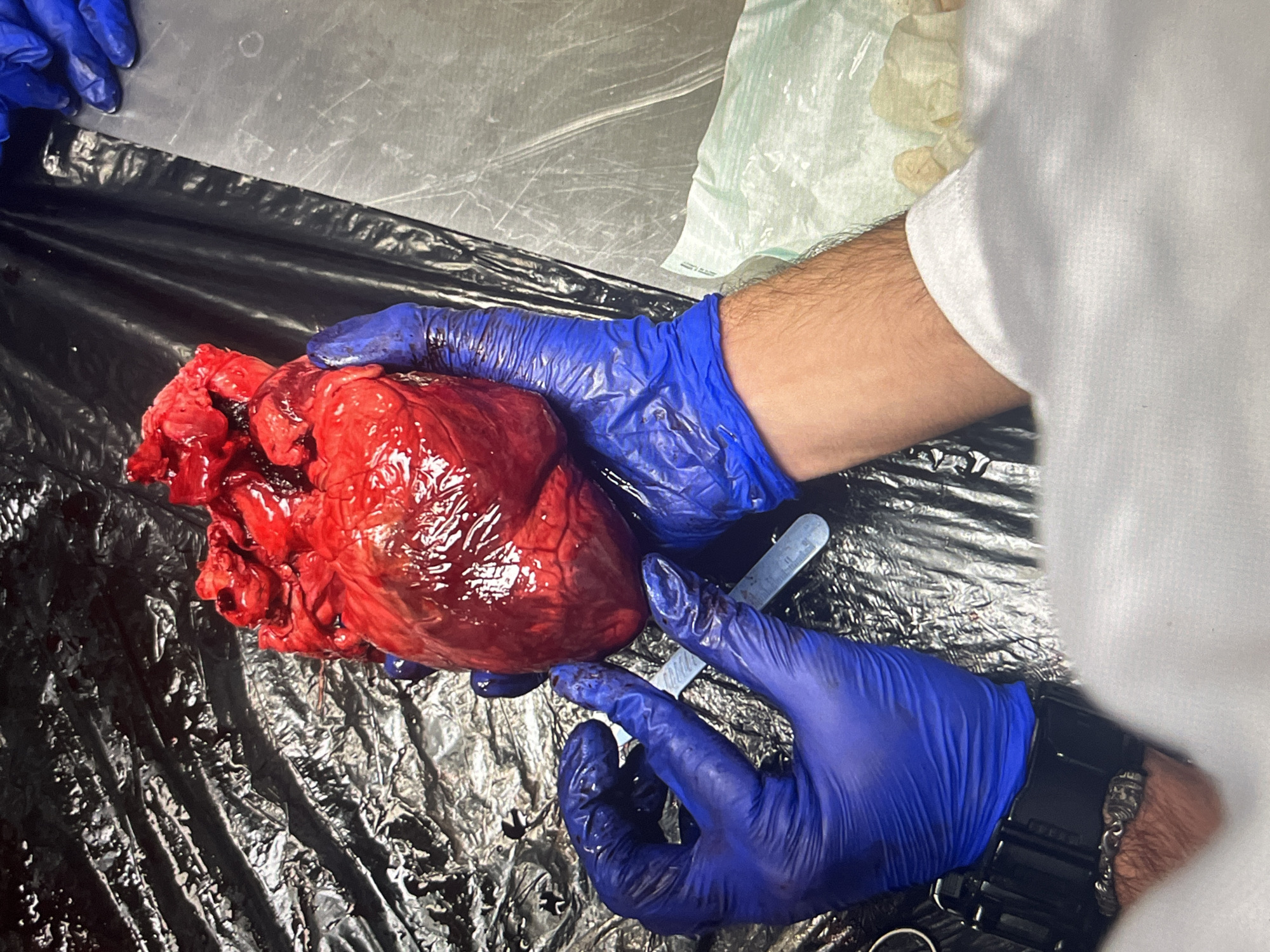 A pair of hands wearing blue surgical gloves holds a red, fresh-looking heart. A silver tool lies beside the heart, on black sheeting. The hands are attached to an arm clad in a white shirt. The location is Unknown, Unknown.