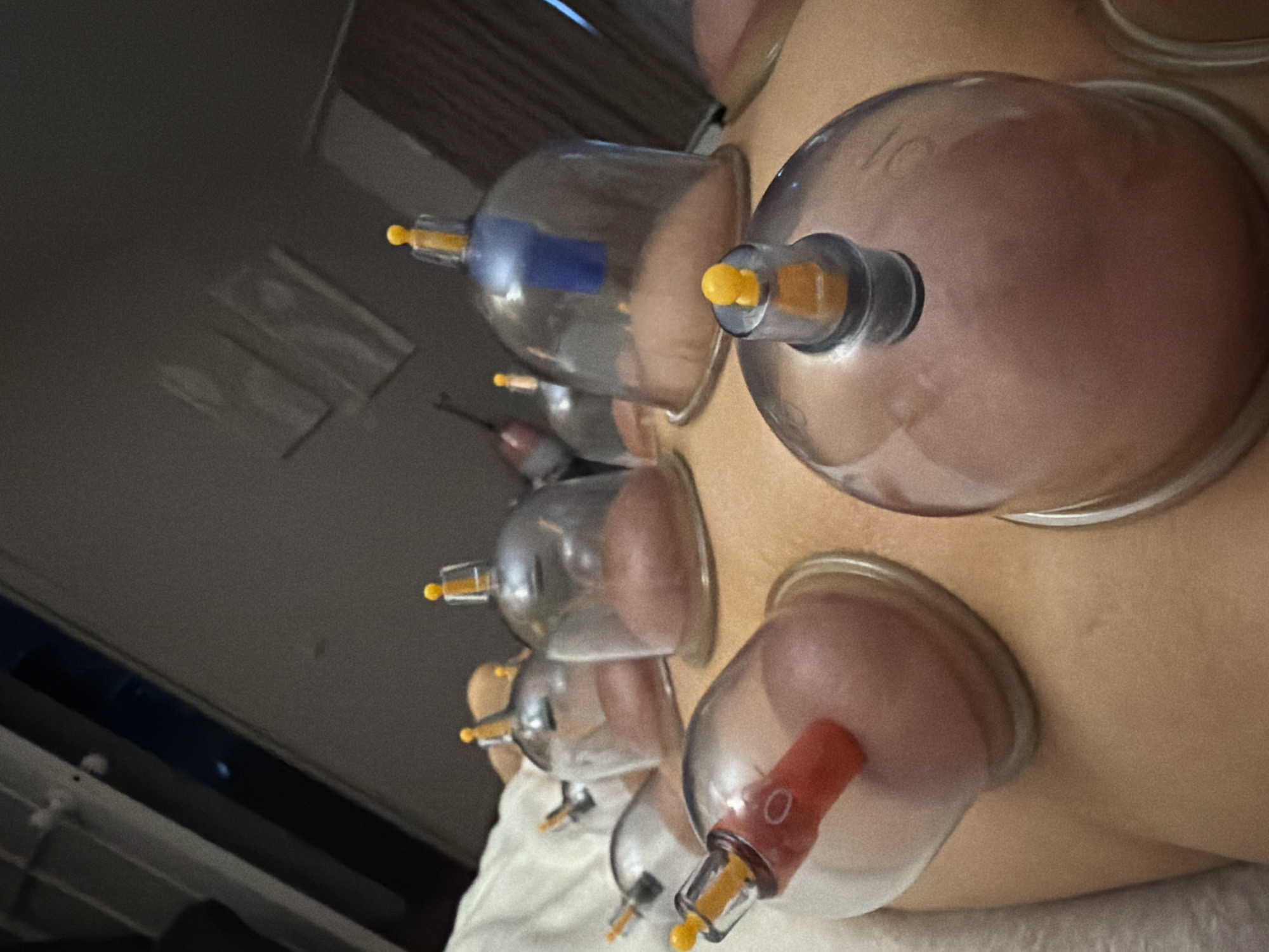 The image shows a back cupping therapy session. Multiple glass cups are attached to a person's skin, creating suction. The cups have plastic valves on top, some with colored indicators (red, yellow, blue). The skin under the cups appears raised and reddened due to the suction. The background includes parts of a bed or treatment table with a white sheet, a window, and blurred elements of a room, suggesting an indoor setting, possibly a clinic or spa. There is no visible information to confirm the location in St. Petersburg, Russia.