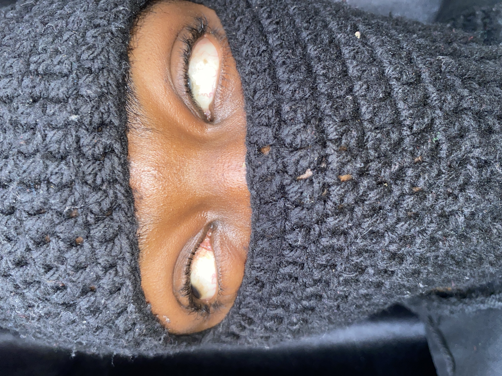 A close-up image depicts a person's eyes, visible through a gap in a dark, coarse-knit fabric, possibly a balaclava or hooded garment. The person has dark skin. The eyes are open, revealing white sclera with visible blood vessels and possible inflammation or irritation. No further details about the person, specific actions, or environment can be determined from the image. The location of Barakin Akawo, Nigeria, cannot be verified and appears unrelated to the visible content.