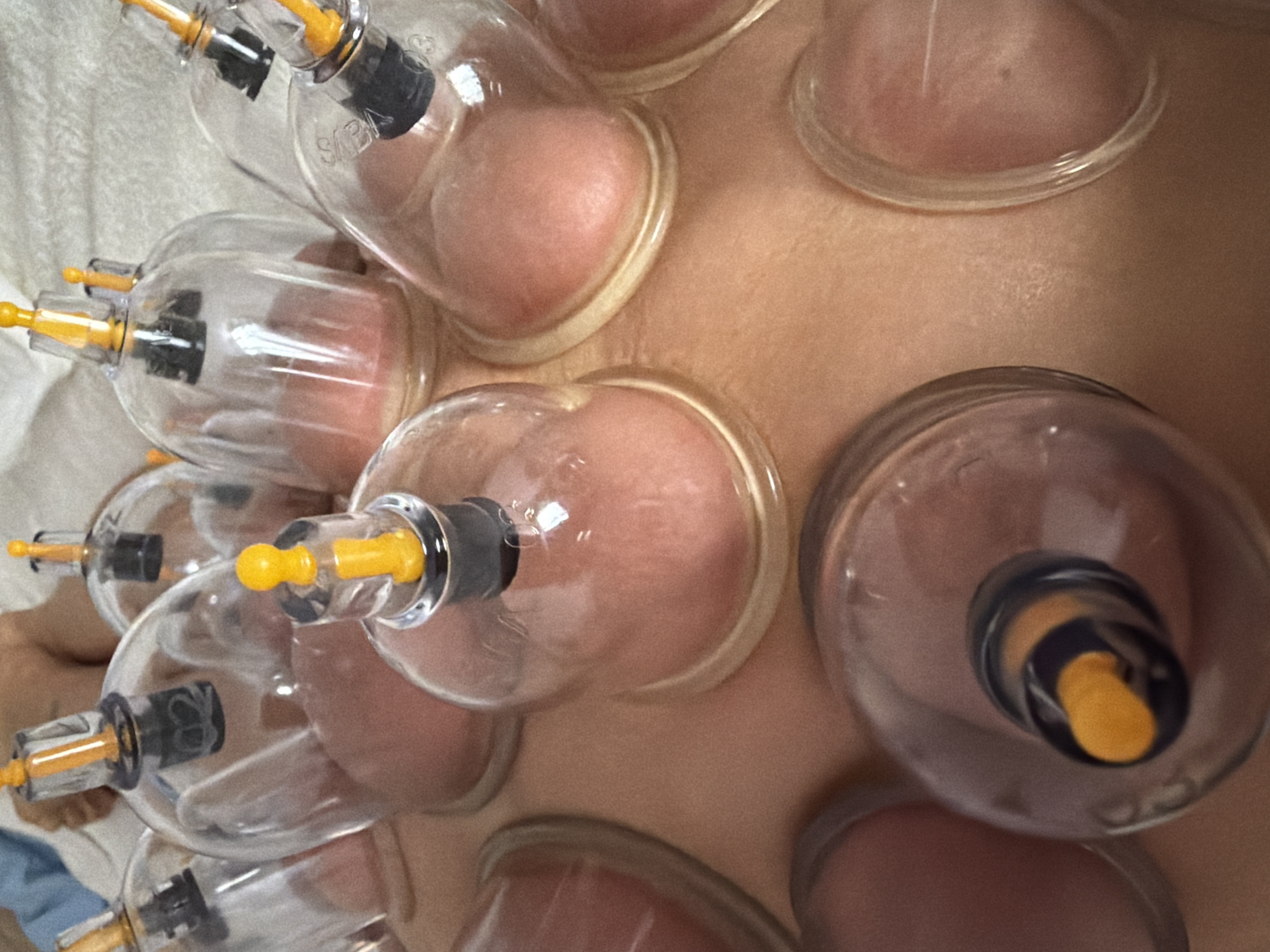 The image depicts a close-up view of cupping therapy being performed on a person's back. Several transparent glass cups with yellow and black suction mechanisms are attached to the skin, creating raised, circular areas of flesh within the cups. The skin surrounding the cups appears light brown. There are no visible landmarks to determine the location within Saint Petersburg, Russia. No interactions are seen.