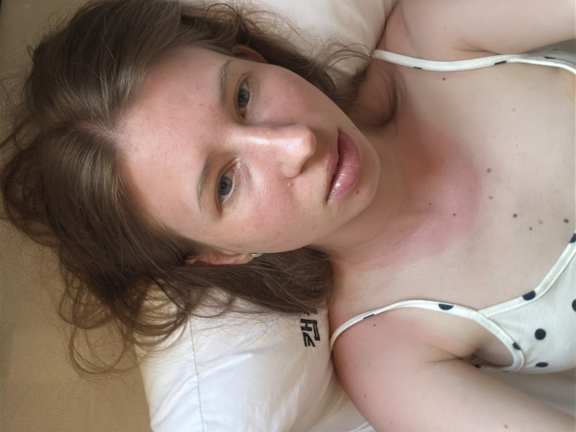 A young woman with fair skin and reddish skin tone from sunburn is lying on a white pillow. Her eyes are open and looking upwards. Her hair is long and brown, spread across the pillow. She is wearing a white tank top with black polka dots. The pillow has some Korean text printed on it. The background appears to be a light brown wall. The image seems to be taken from a high angle, looking down at the woman. The woman's shoulders and upper chest show clear signs of sunburn.