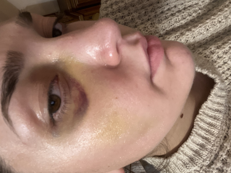 The image shows a close-up of a person's face, appearing to be a woman, from a low angle. There is discoloration around the eye, suggesting bruising. The skin appears pale and somewhat shiny. A beige, knitted sweater is visible along the neck. The background includes glimpses of furniture, possibly a dresser.