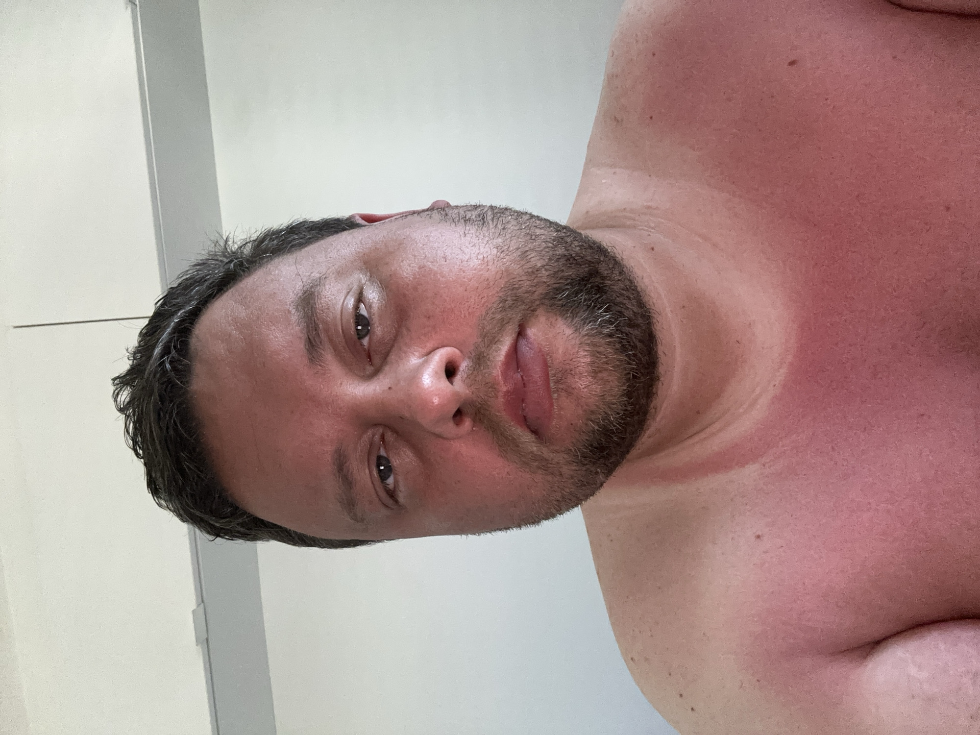 A close-up, slightly rotated image shows a man from the chest up. He has a beard and short, dark hair with some grey strands. His face and chest are flushed red, indicating sunburn. A distinct red line marks the border of the sunburn on his upper chest and shoulders. The background is a plain white wall. The location in Sant Feliu de Guíxols, Spain is not evident from the image.