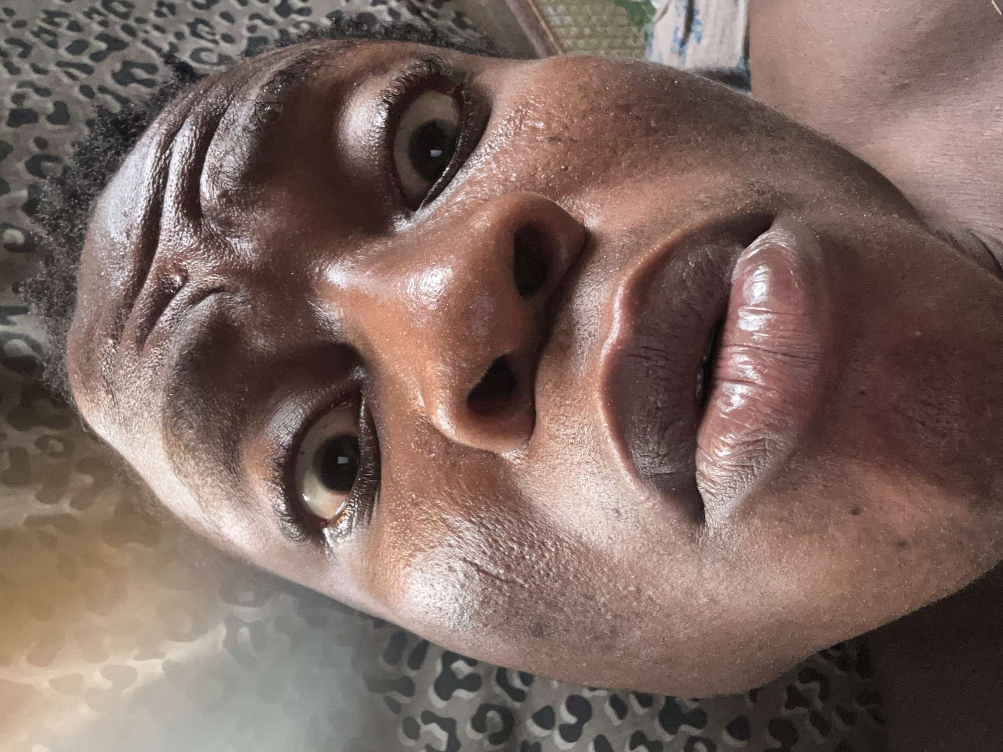 A close-up, high-angle portrait captures the face of a person, likely of Black ethnicity, who is lying down. The face is tilted significantly, with the person looking directly at the camera with wide-open eyes. Prominent wrinkles are visible on the forehead, suggesting an expression of intensity or surprise, or simply the effect of the angle. The skin appears shiny and oily or sweaty, with visible pores and some minor blemishes, particularly on the forehead, nose, and cheeks. Dark, curly hair is visible at the hairline. The lips are slightly parted, revealing the lower lip's inner texture. The background is a blurred, dark fabric with a leopard or cheetah print pattern, indicating an indoor setting, possibly a bed or couch. No text is visible in the image. The lighting appears to be natural, creating highlights on the shiny skin.