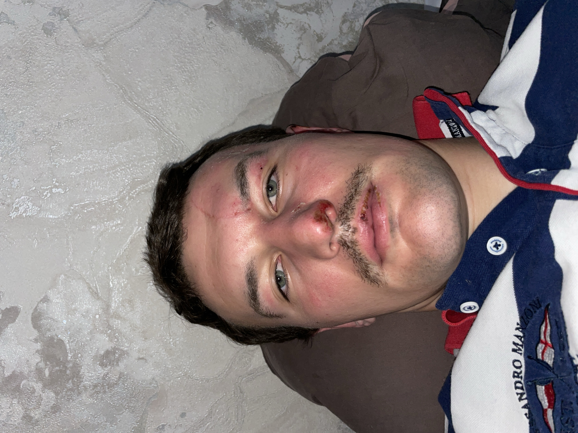 A close-up, tilted, low-angle shot depicts a man with apparent facial injuries. He is lying on a brown pillow or cushion, with a textured white surface, possibly a wall or bedding, in the background. The man's injuries include a cut on his forehead, abrasions on his nose and upper lip, and redness on his cheeks. He has dark hair and a mustache. He is wearing a navy blue and white shirt with red accents and the words "SANDRO MANZONI Yachting" embroidered on it. The location is not identifiable as Sochi, Russia, based solely on the provided image.
