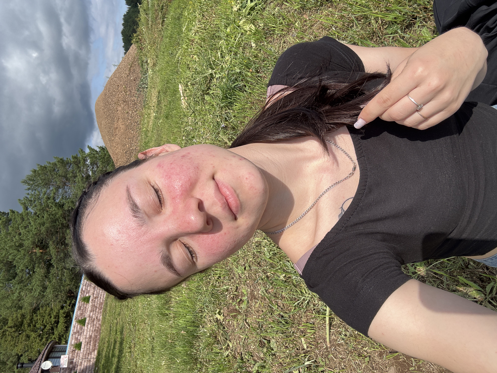 In Pozdyshki, Russia, on a sunny day, a young woman with her eyes closed sits on grass. Her face exhibits redness and some acne. She wears a black t-shirt and is adorned with silver necklaces and rings. In the background, a large pile of gravel sits near a dense line of trees, with a building and more trees visible on a hill to the left. The sky is partly cloudy.