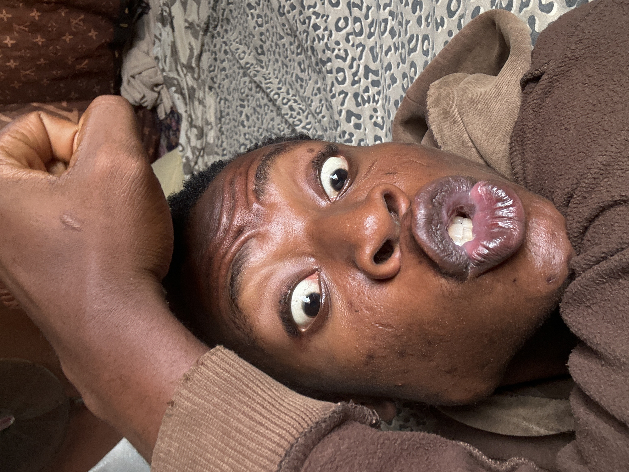 The image shows a dark-skinned person lying down, looking up at the camera. The person has swollen, discolored lips, possibly due to an injury or medical condition. Their eyes are wide open. The person is wearing a brown sweatshirt. The background includes a bed with patterned sheets and blankets. The location is unknown.
