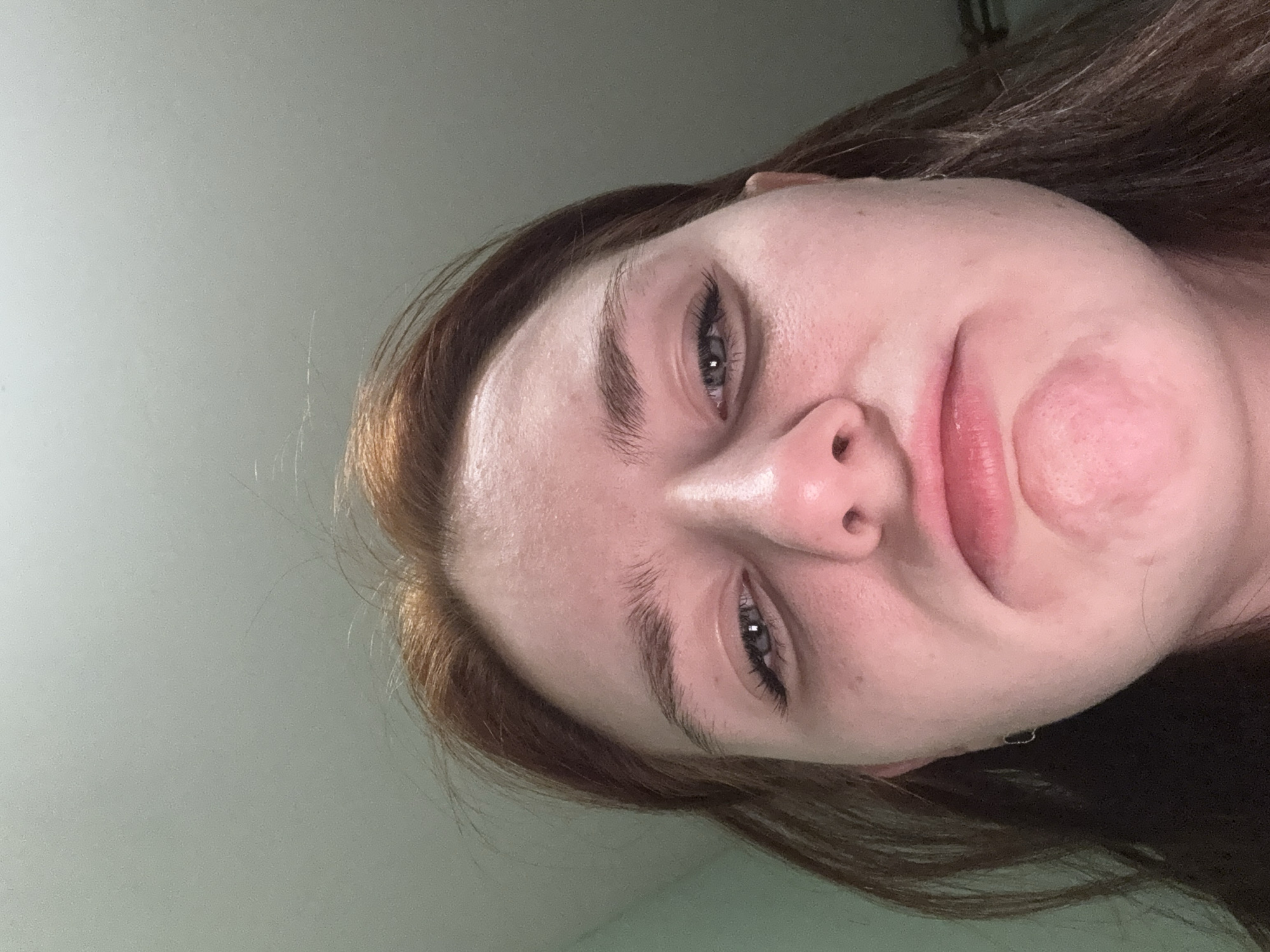 The image shows a close-up, tilted view of a person's face. The person has fair skin, blue eyes, and auburn hair. There is a noticeable circular area of redness on their right cheek. The background appears to be a plain, light-colored wall. Location: Unknown, Unknown.