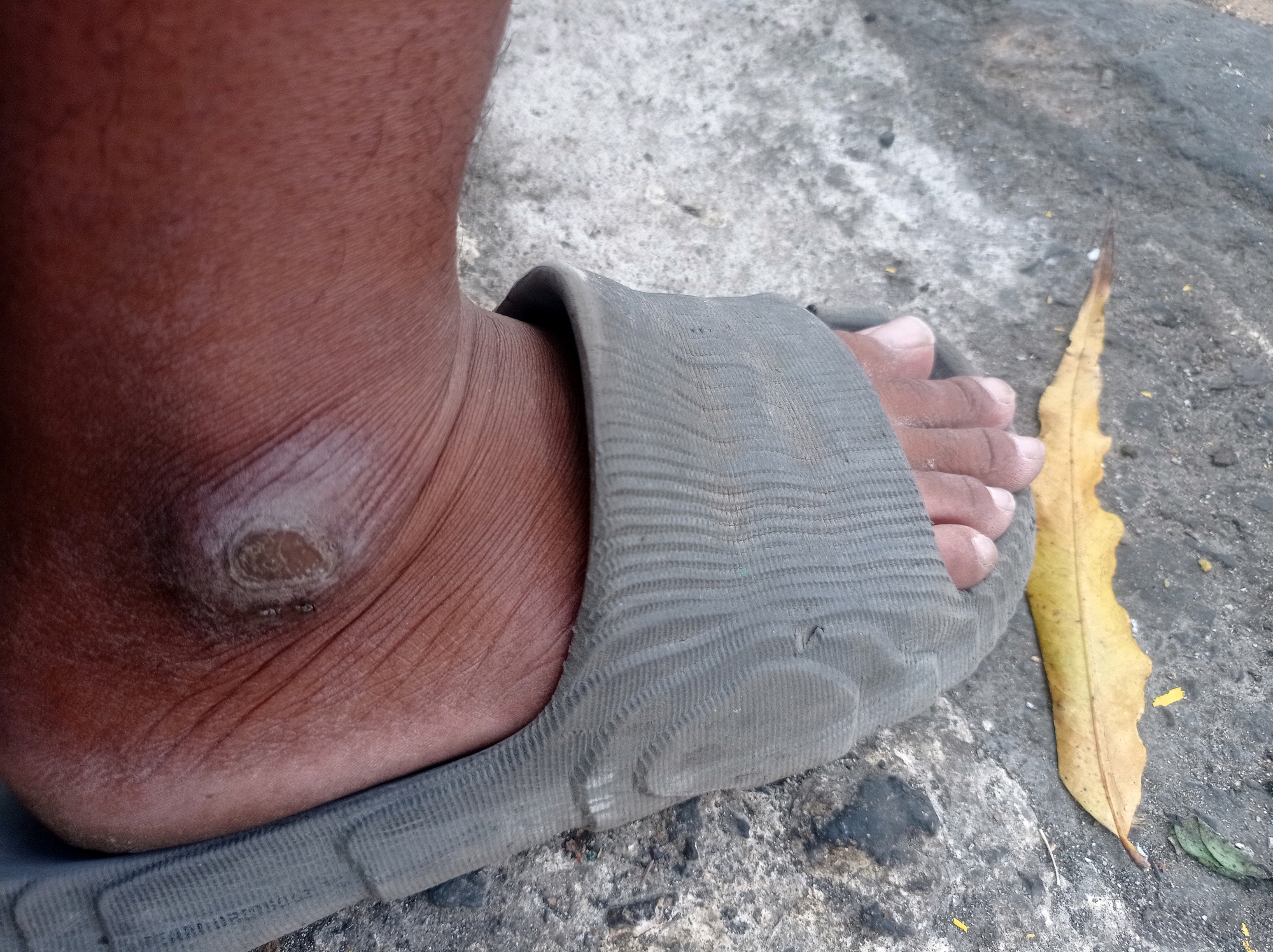 A close-up, eye-level shot focuses on the side of a person's right foot and ankle, shod in a gray sandal, resting on a rough, gray concrete surface. The skin of the ankle is dark brown and appears dry with visible wrinkles. A prominent, raised, circular lesion, approximately 2 cm in diameter, is present on the outer side of the ankle, characterized by a rough, textured surface with lighter brown and grayish tones, and a central indentation. Two small, dark specks are visible within this lesion. The sandal is made of a flexible, gray material with a ribbed texture and shows some wear. To the right of the foot, a single, dried yellow leaf lies on the concrete. The background consists of the textured gray concrete, with some scattered small pebbles and dark patches suggesting moisture or dirt. The overall lighting is somewhat diffused, casting soft shadows. The scene is presumed to be in Tuban, Indonesia, based on context provided.