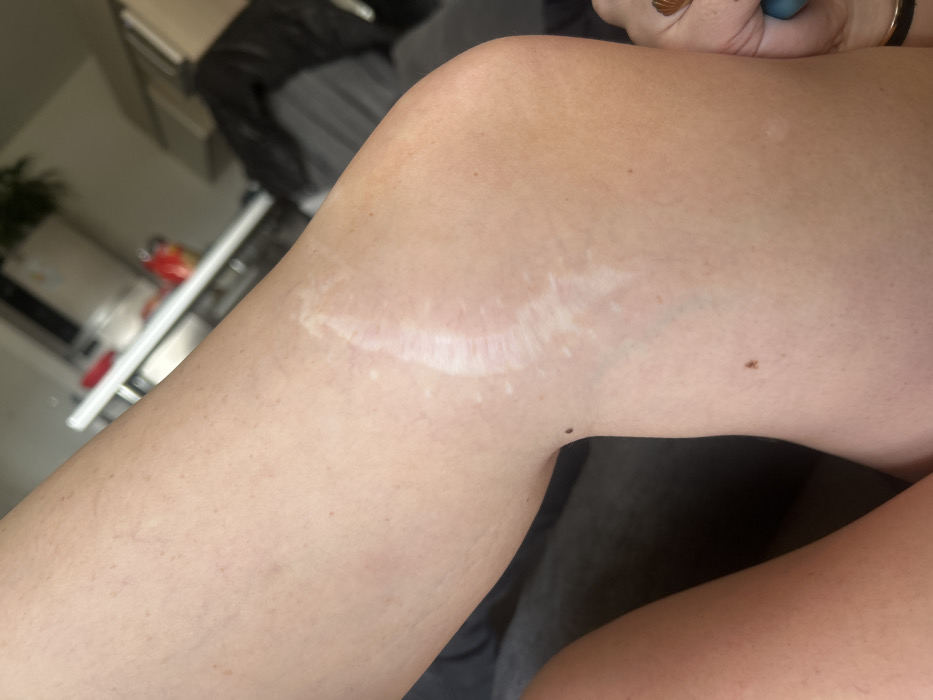 The image shows a close-up view of a person's upper leg, likely the thigh area near the knee. The dominant feature is a long, light-colored scar that runs horizontally across the front or outer side of the leg. The scar is irregular in shape, somewhat wavy or crescent-like, and appears slightly raised and a lighter, almost white tone compared to the surrounding skin.
The skin on the leg is a light to medium tone, with visible pores and scattered small dark spots, consistent with freckles or moles. Faint veins are also discernible beneath the skin in some areas. The leg is slightly bent, indicating a resting position.
In the top right corner of the original image, part of a hand is visible, adorned with rings on the fingers and painted nails, suggesting the person is holding a camera or phone to take the picture of their own leg.
The background is out of focus, creating a shallow depth of field that keeps the leg as the primary subject. The blurred background suggests an indoor setting, possibly a domestic environment like a kitchen or living room. Hints of light-colored surfaces, potentially a countertop or table, and darker shapes, possibly furniture or clothing, can be vaguely made out. A blurry red object, possibly a kitchen appliance like a kettle, is faintly visible in the distant background.
The lighting appears to be ambient indoor light, creating soft shadows and highlights on the skin and scar. There is no visible text in the image.