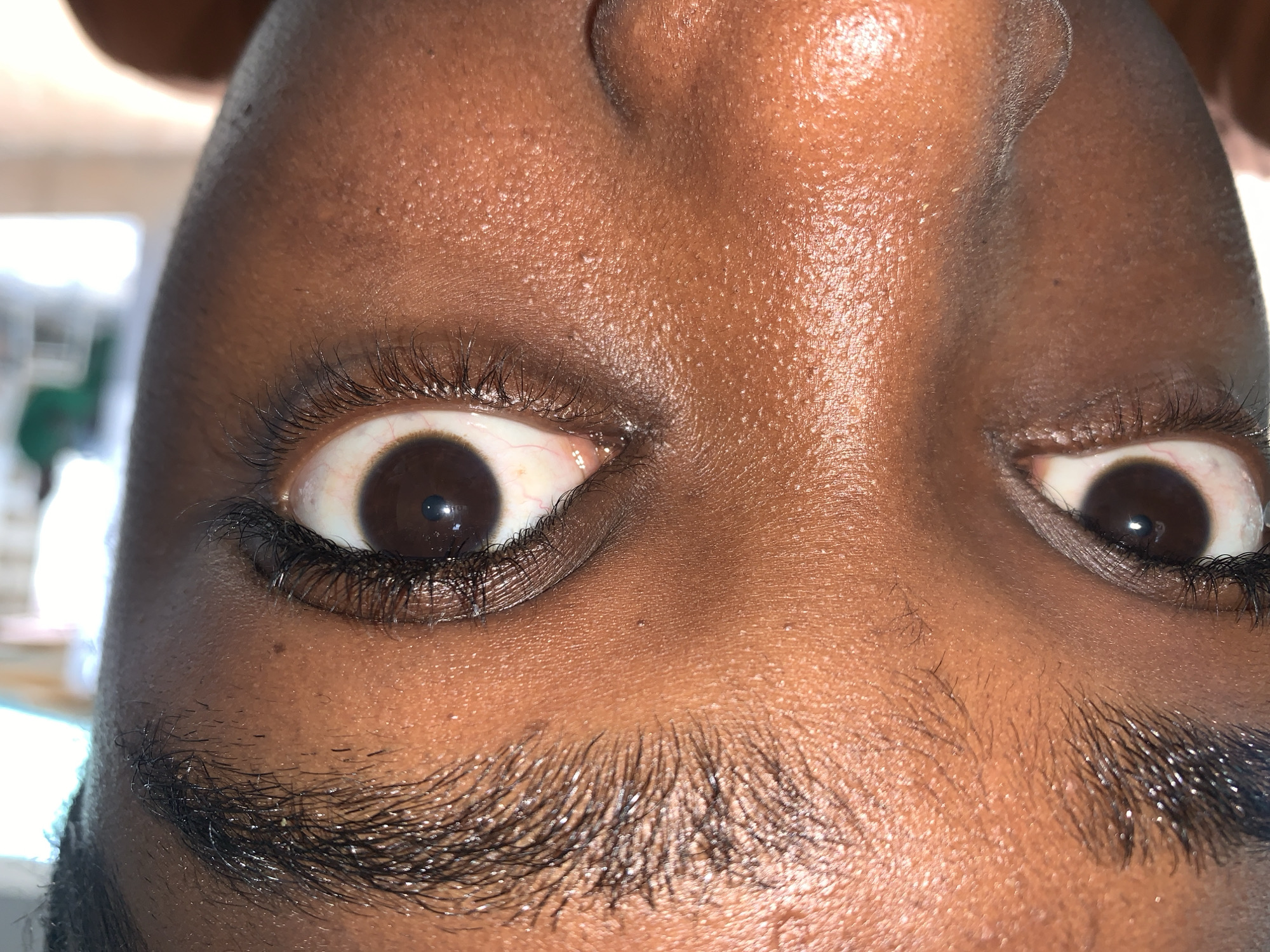 A close-up, frontal portrait focuses on the eyes and upper facial features of a person with dark brown skin. Both eyes are open, looking directly at the viewer. The irises are deep brown, with visible, constricted pupils. The whites of the eyes (sclera) show some faint reddish capillaries, particularly in the viewer's left eye. Dark, long eyelashes are visible on both upper and lower lids, appearing full. The eyebrows are dark, dense, and naturally textured, with some finer hairs extending above the main brow line.
The skin tone is a rich brown, exhibiting visible pores across the forehead, upper nose, and cheekbones. A slight sheen is present on the skin, suggesting natural oils or moisture. Numerous small, pale, uniform bumps are visible on the skin, particularly concentrated on the forehead and upper cheek areas. The upper bridge of the nose is partially visible at the bottom center of the frame. Lighting is direct and frontal, creating highlights on the skin and eyebrows. The background is completely out of focus and blurred, showing indistinct lighter areas and some faint green tones, consistent with an interior or sheltered environment. There are no identifiable landmarks or features within the image to confirm the location in New Stadium, Nigeria.