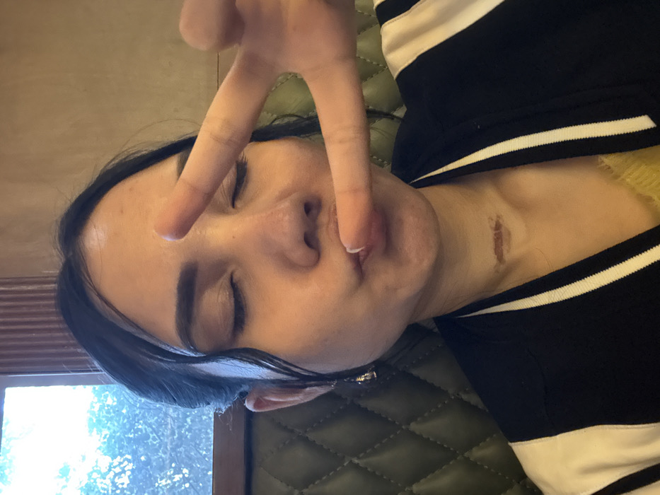 The image presents a headshot of a young adult female in an indoor setting within Kolkata, India. She has dark hair styled back with front strands. Her eyes are closed, and her lips are pursed in a "kissing" pose. Her left hand, appearing in the foreground on the right side of the frame, is raised, forming a "peace sign" with the index and middle fingers extended. A visible, healed, horizontal scar is present on the anterior aspect of her neck. She wears a black jacket featuring white stripes on the sleeves and collar, over a yellow garment partially visible at the neckline. The background consists of a dark green, quilted booth seating to the left, and a window displaying outdoor foliage and ambient light. A plain, light brown wall section is visible on the right side of the background.