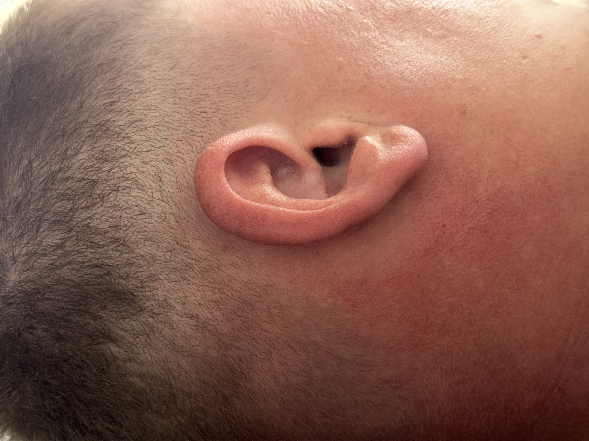 A close-up shot of a person's head, showing the ear and adjacent areas. The ear is pink, with visible details of its structure. The skin around the ear is reddish. The person has dark hair that is short and cropped close to the head. No specific location within the city of Chaikovsky, Russia is identifiable in the image. There are no actions or interactions visible.