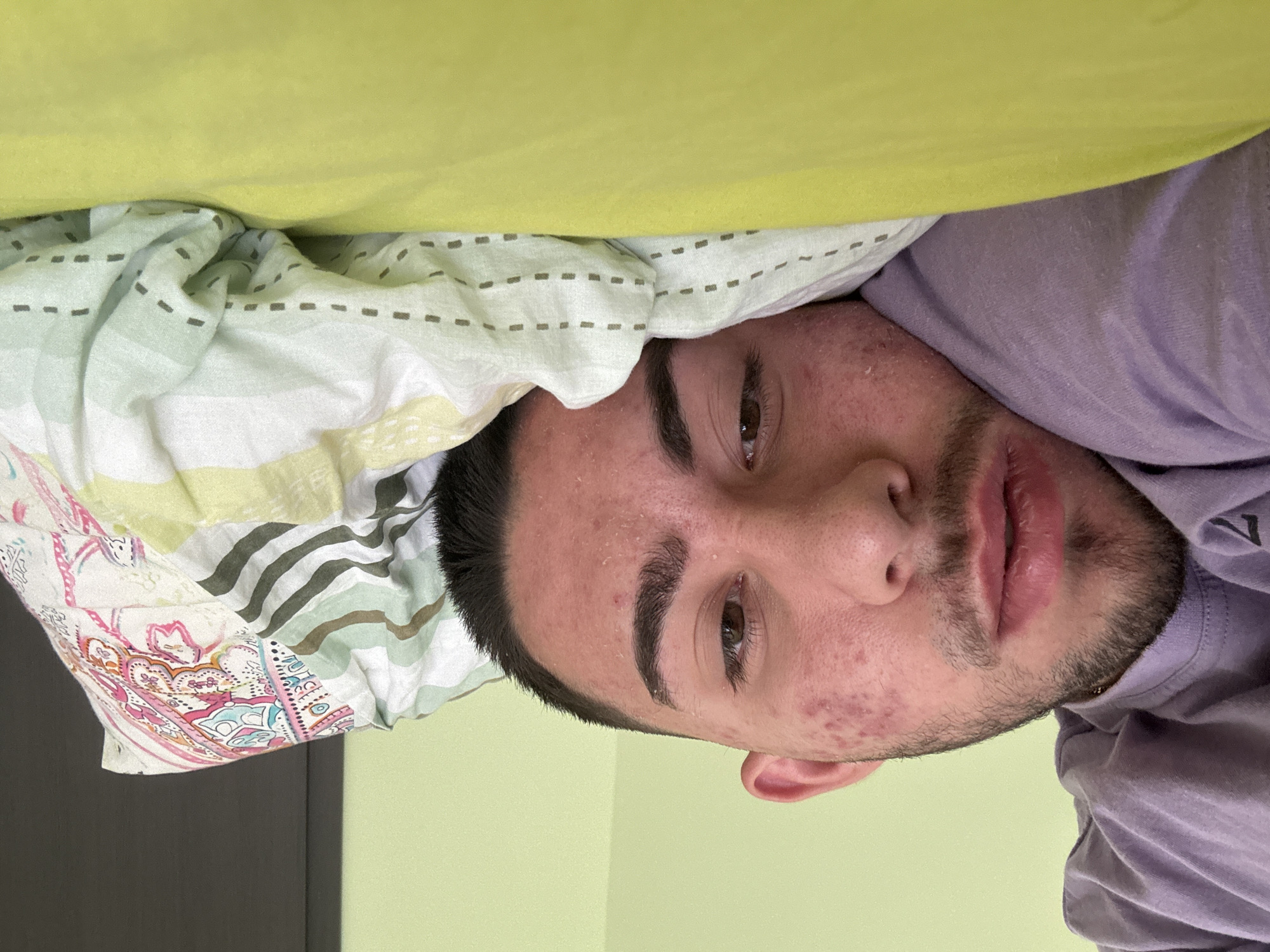 A young man, likely in his late teens or early twenties, is depicted lying in a bed, looking directly at the camera. The image is oriented sideways, with the man's head on the right side of the frame and his body extending to the left. He has short, dark hair, neatly trimmed eyebrows, and dark eyes. Stubble covers his chin and upper lip. Visible skin imperfections, such as acne or red spots, are present on his forehead, cheeks, and chin, with some flakiness on his forehead. His lips appear chapped.
He is wearing a light purple or lavender t-shirt. A plain light green blanket covers part of his head and lies above him. His head rests on a pillow featuring a patterned pillowcase with light green, white, and grey stripes, and a colorful paisley or floral design in shades of pink, blue, and yellow. The background shows a light green wall, with a dark, vertical element, possibly a door frame or piece of furniture, visible on the left side of the frame. The setting appears to be a bedroom in Blagoevgrad, Bulgaria. His expression is neutral, and there is no visible text.