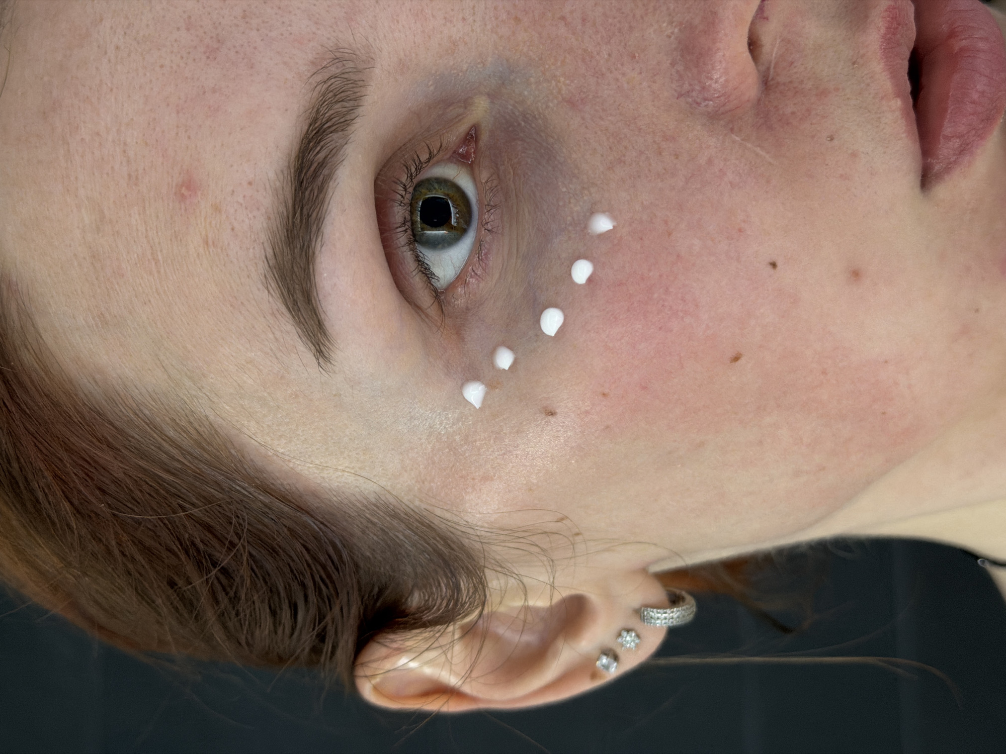 A close-up, angled shot of a woman's face. White dots of cream are placed under her eye. She has fair skin with freckles and her brown hair is visible on the side of her face. Her ear is pierced with multiple earrings. The background is dark and blurry. The location in Chaikovsky, Russia is unknown.